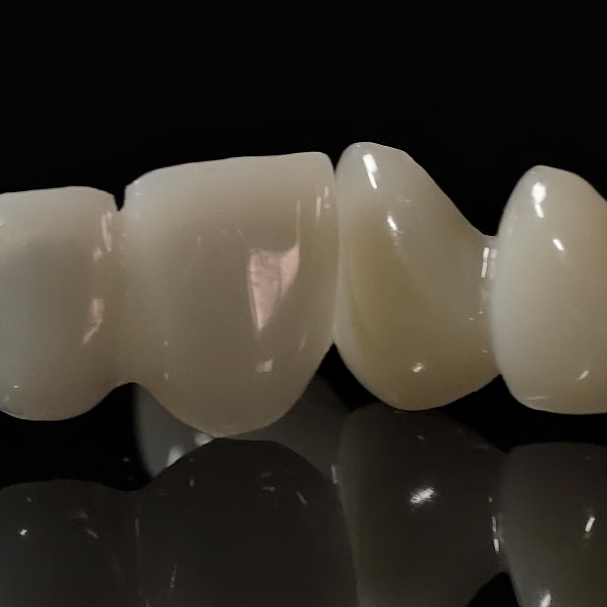 PMMA Bridge Veneer With Cement Retained