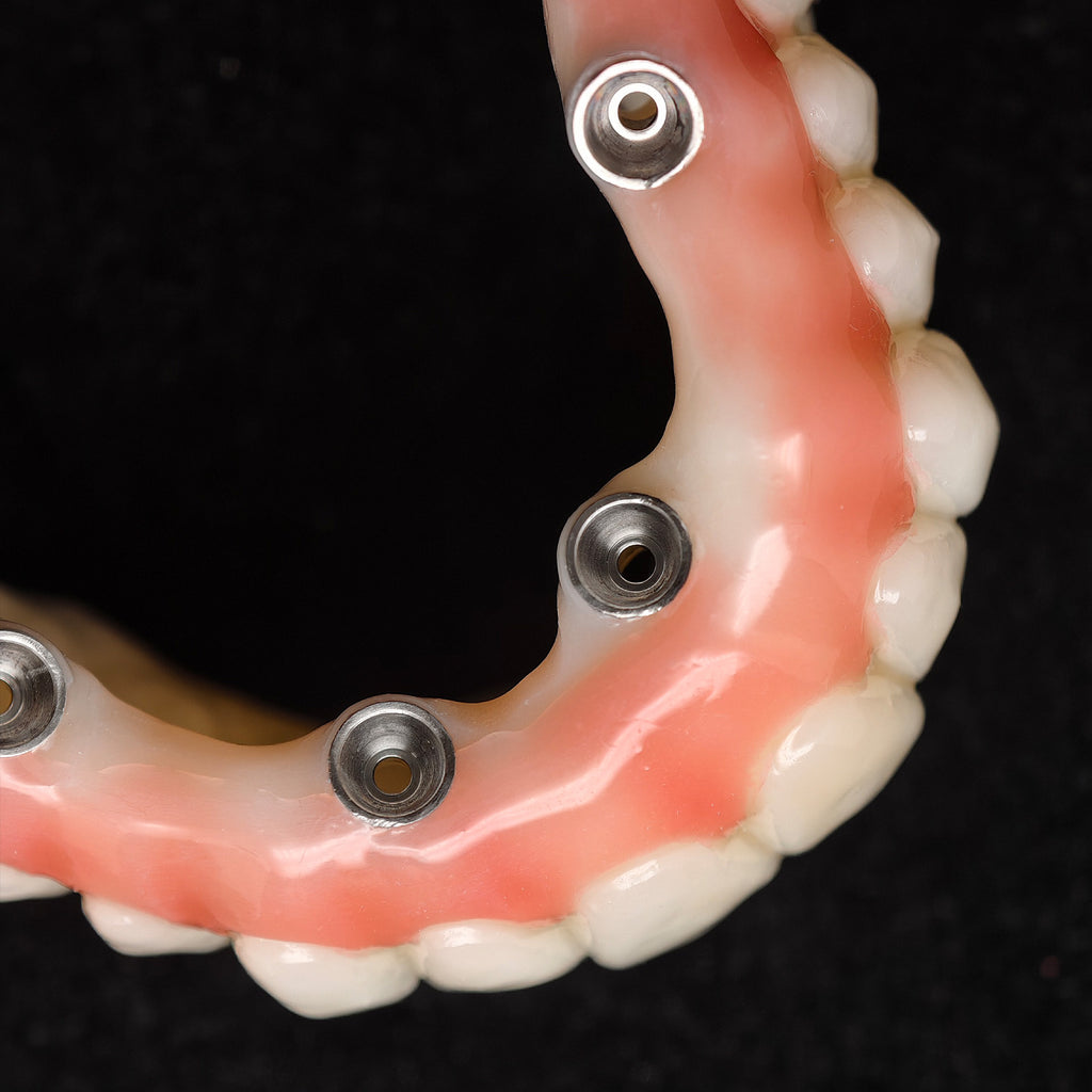 PMMA Bridge With Ti-Base Screw Retained Trying For Full Arch Restoration