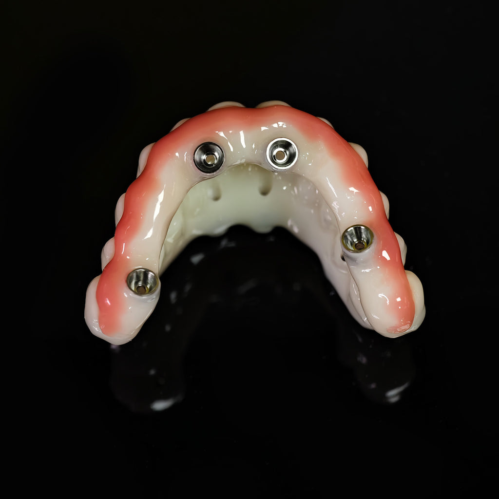 PMMA Bridge With Ti-Base Screw Retained Trying For Full Arch Restoration
