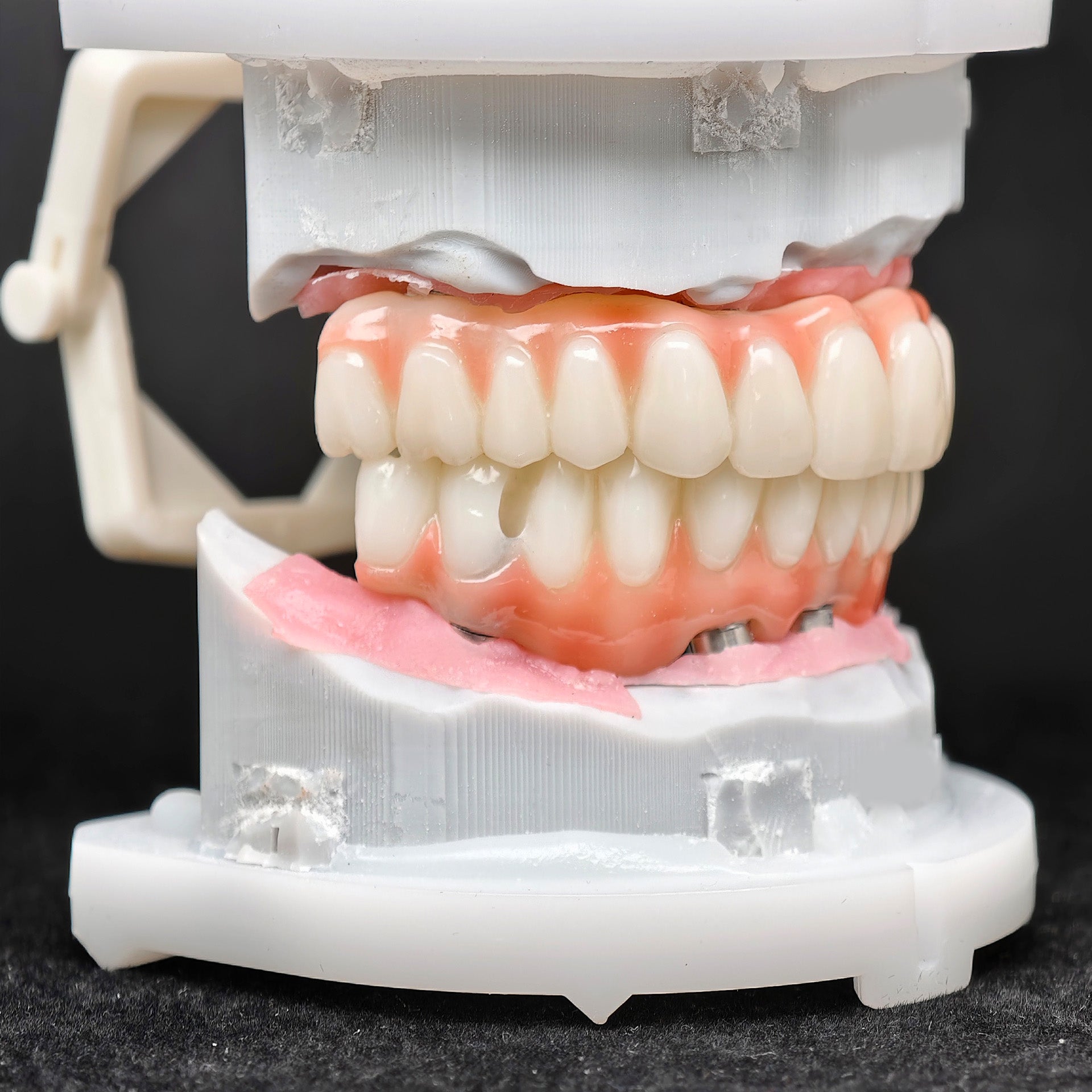 PMMA Bridge With Ti-Base Screw Retained Trying For Full Arch Restoration
