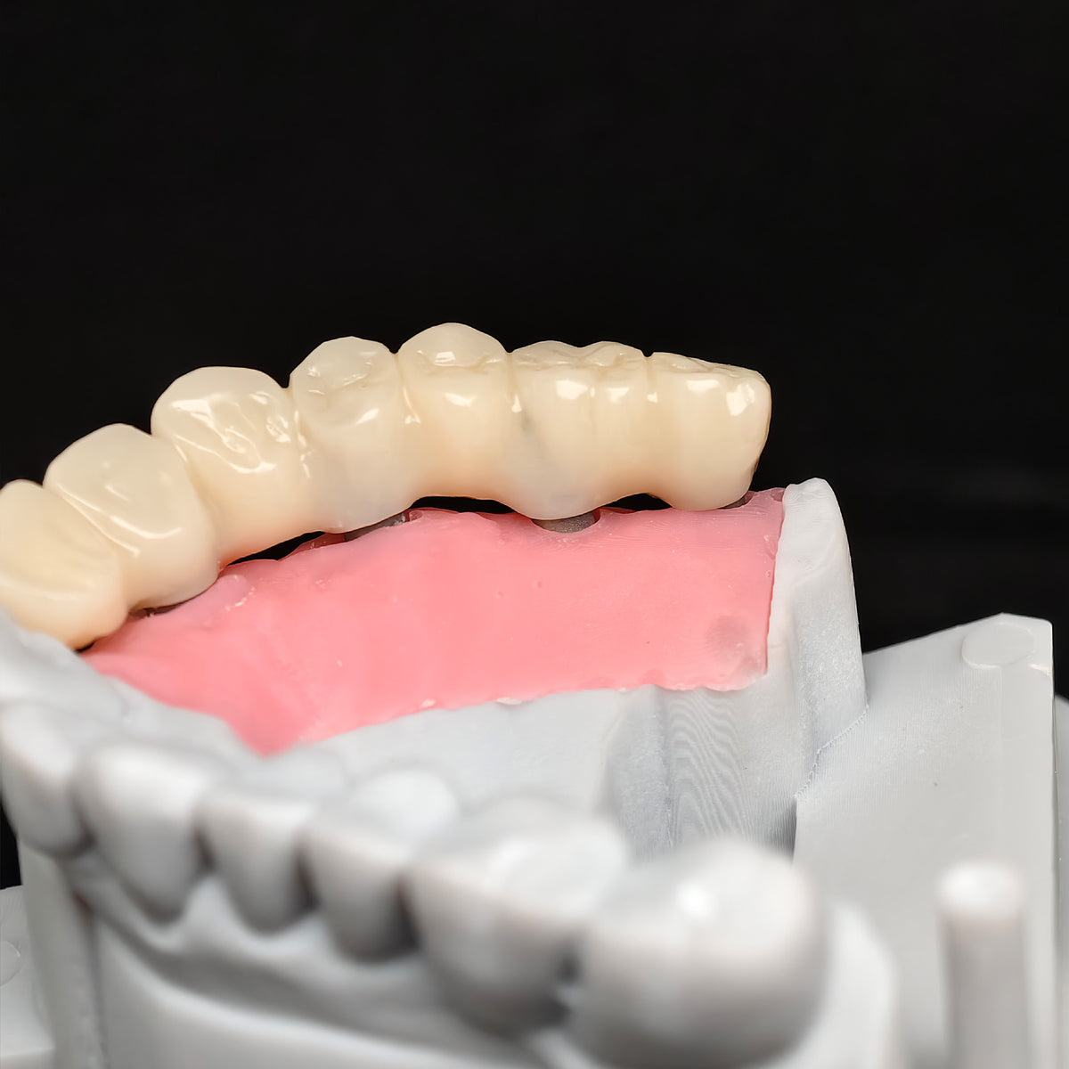 PMMA Bridge With Custom Abutment And Implant Seating Guide