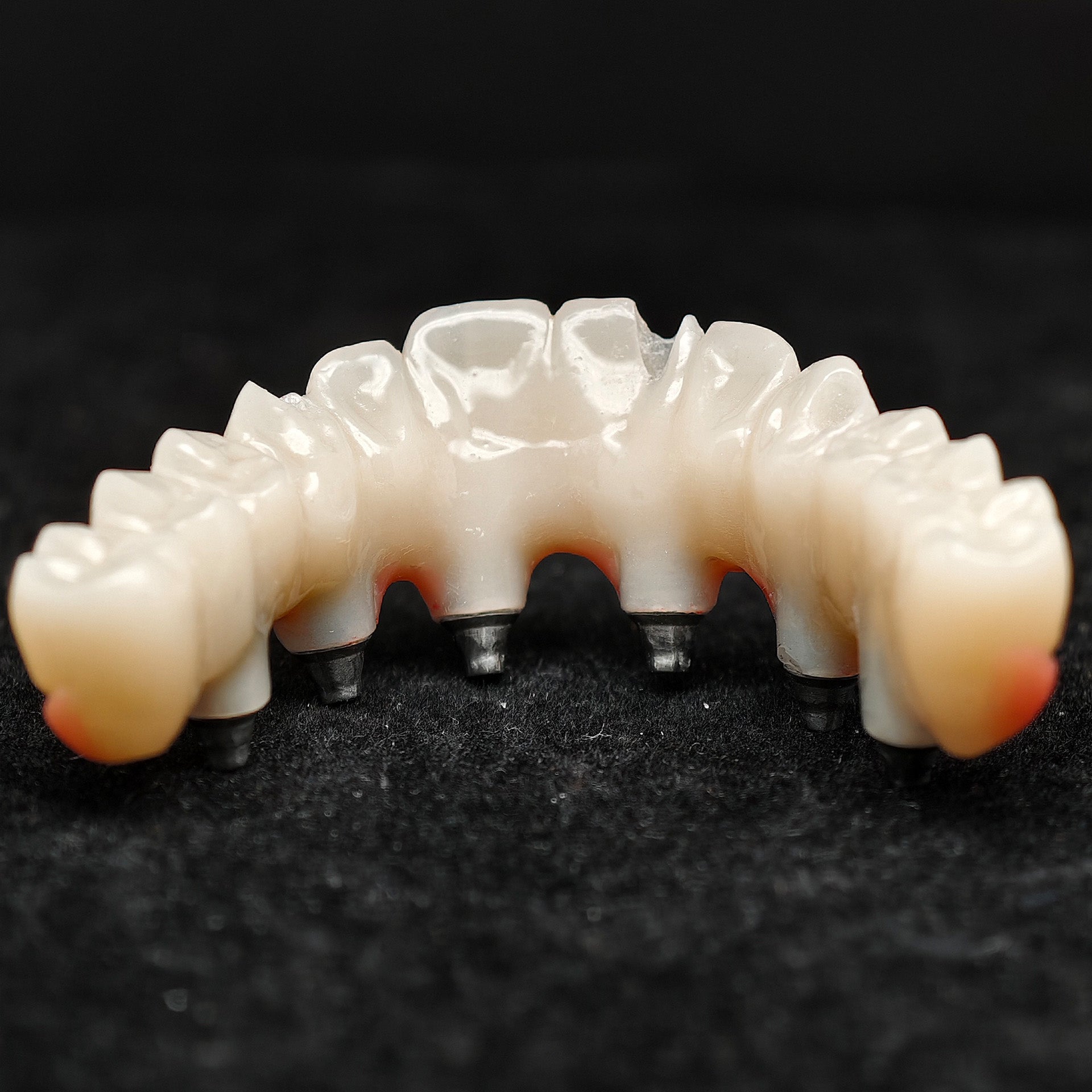 Pmma Bridge With Screw-Retained