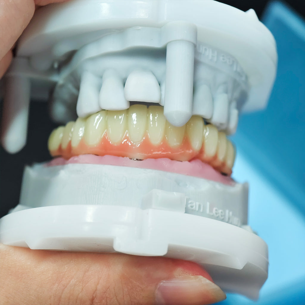 PMMA Bridge With Screw Retained