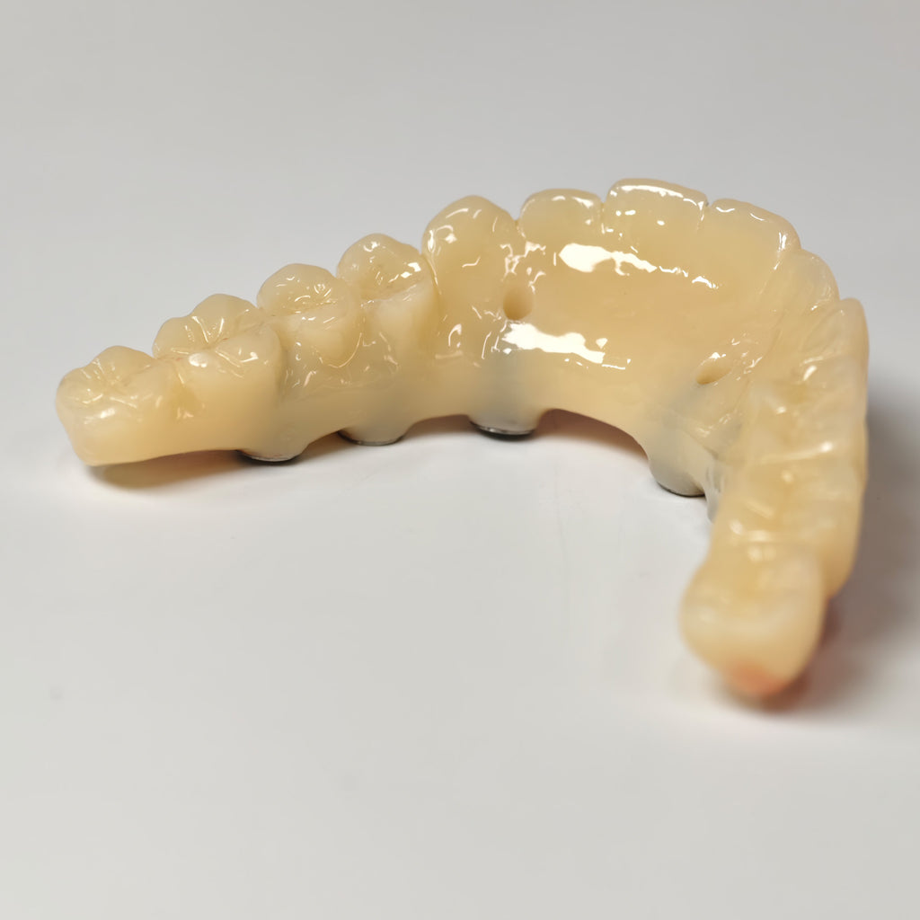 PMMA Bridge With Screw Retained