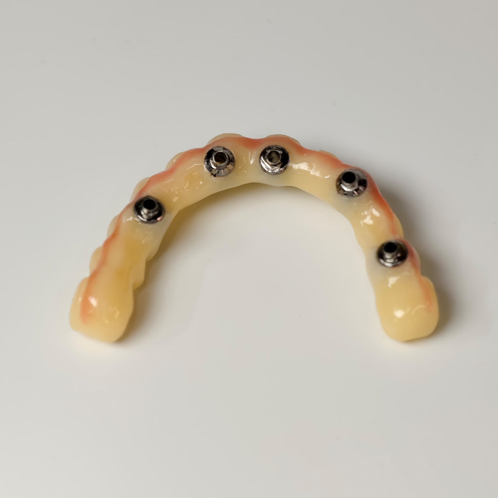PMMA Bridge With Screw Retained