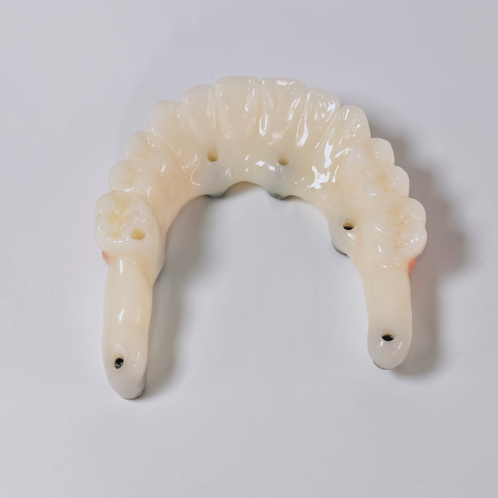 PMMA Bridge With Screw Retained