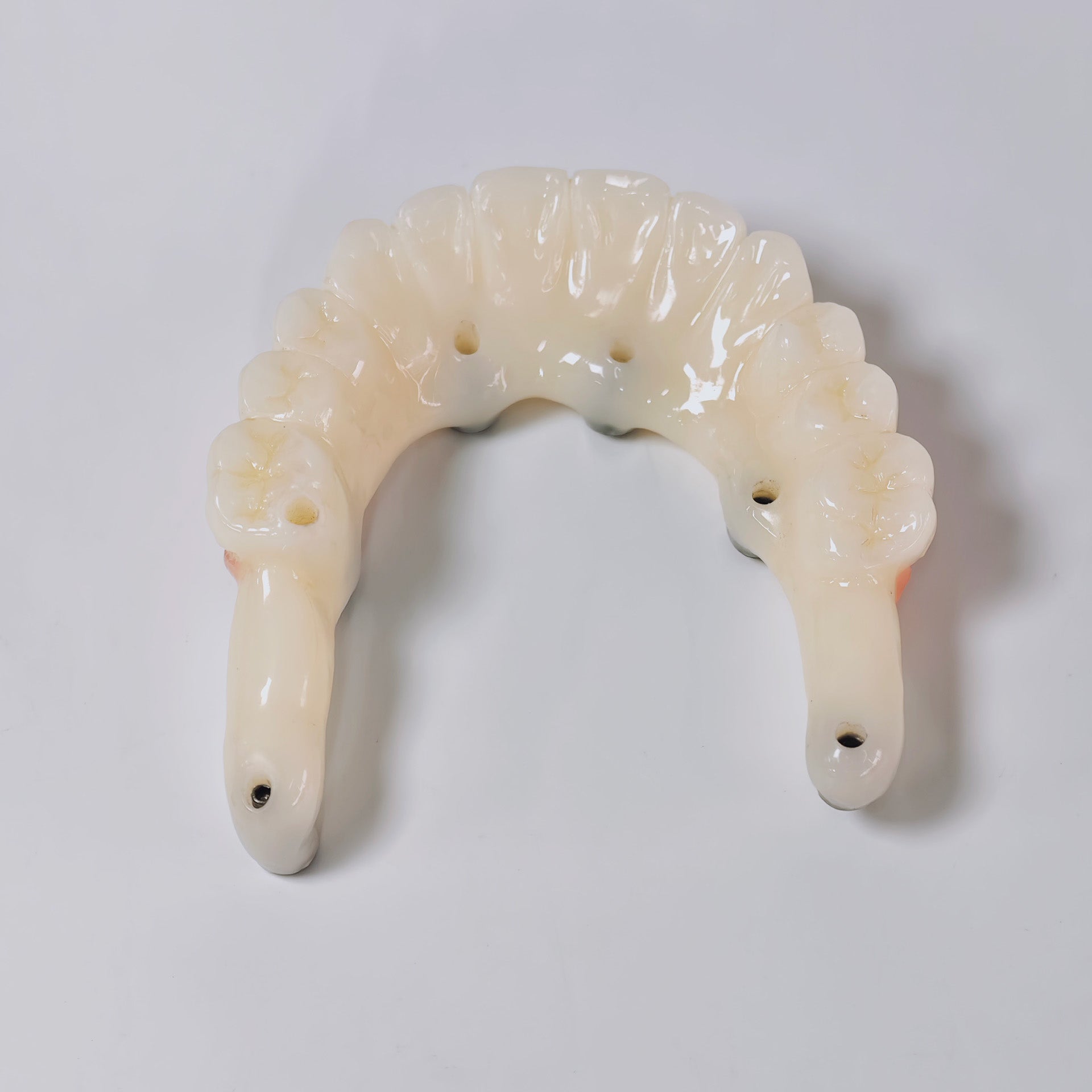 PMMA Bridge With Screw Retained