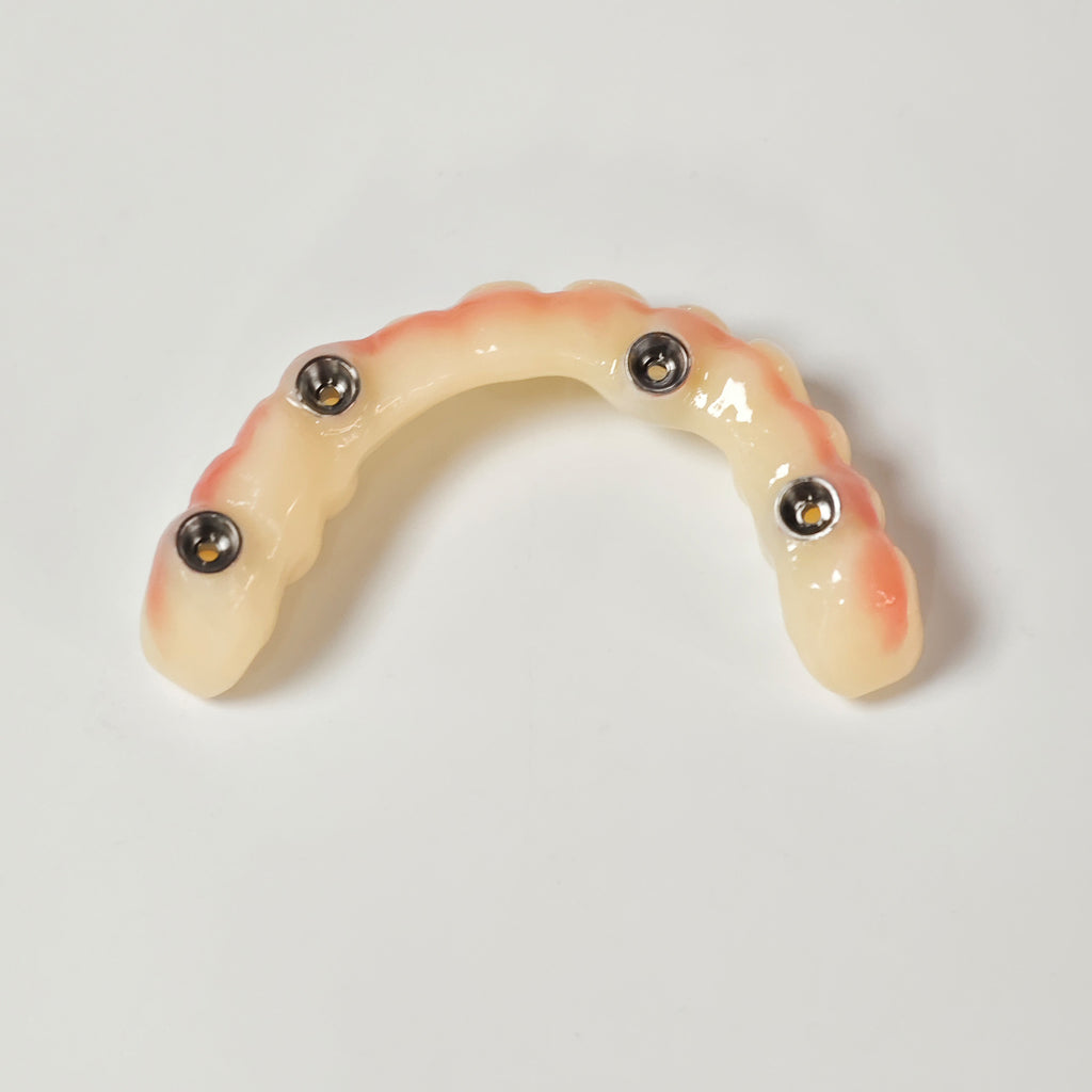 PMMA Bridge With Screw Retained