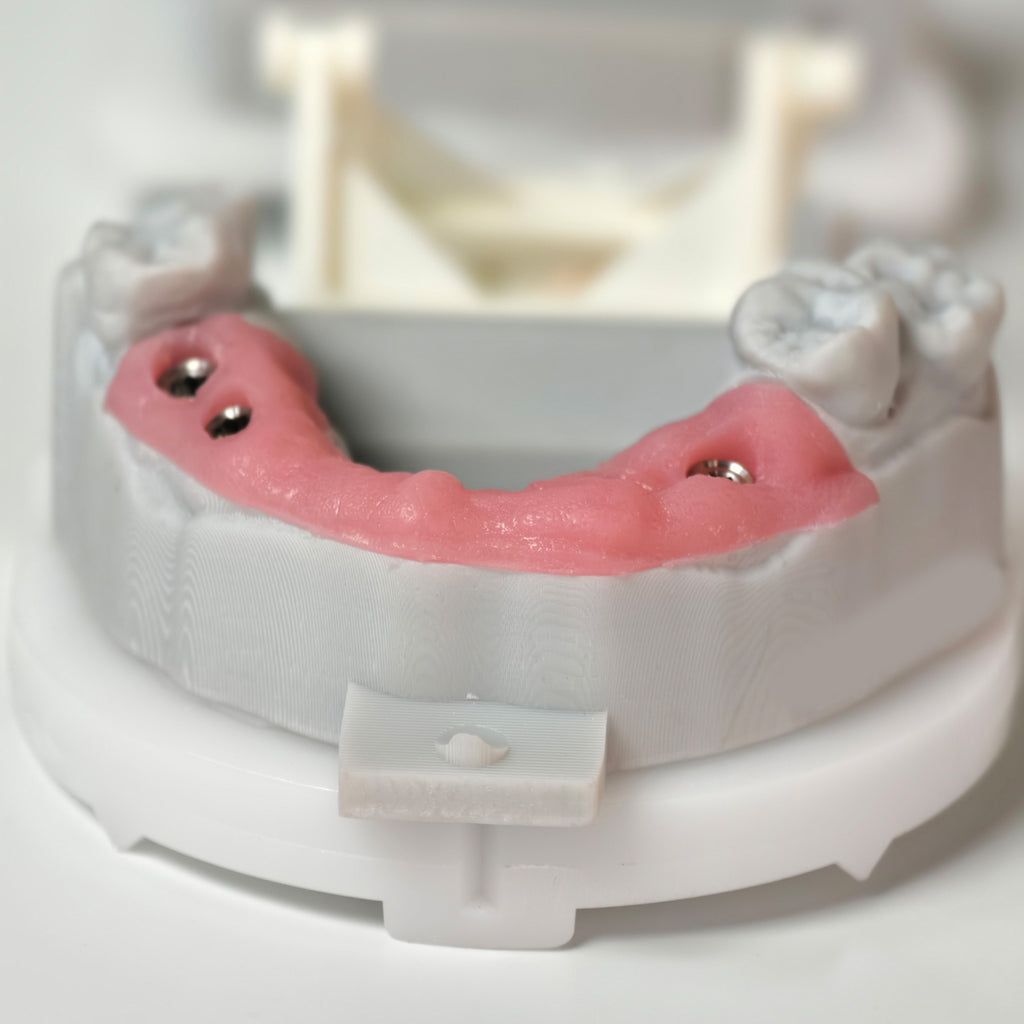 PMMA Bridge With Screw Retained