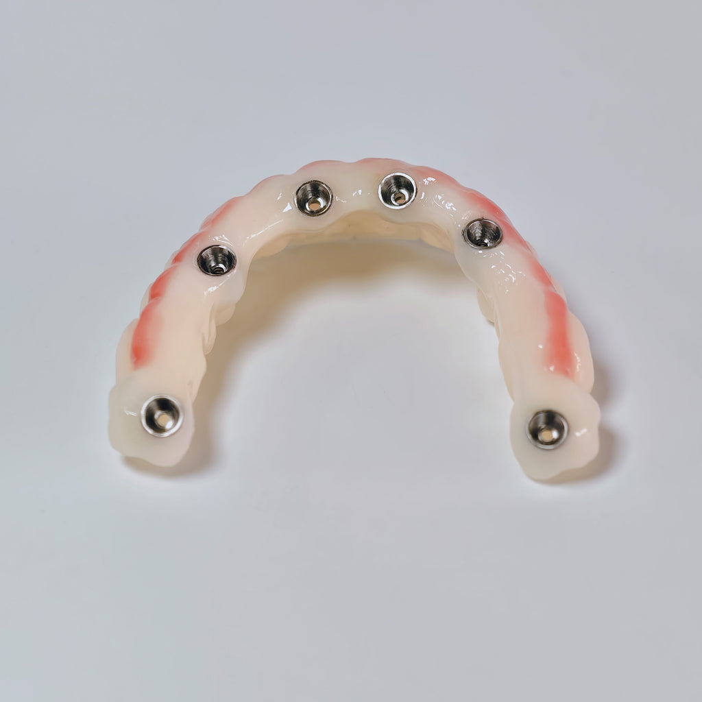 PMMA Bridge With Screw Retained