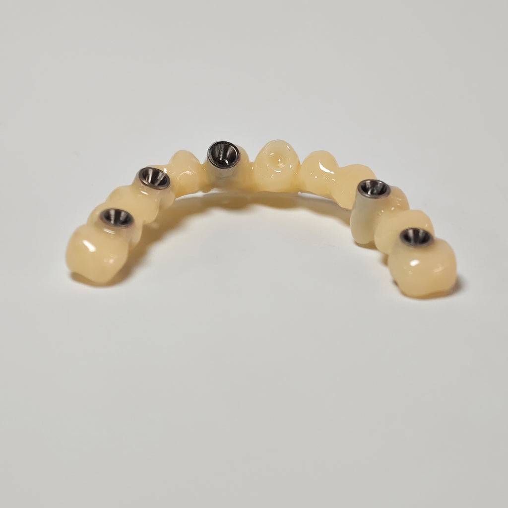 PMMA Bridge With Screw Retained