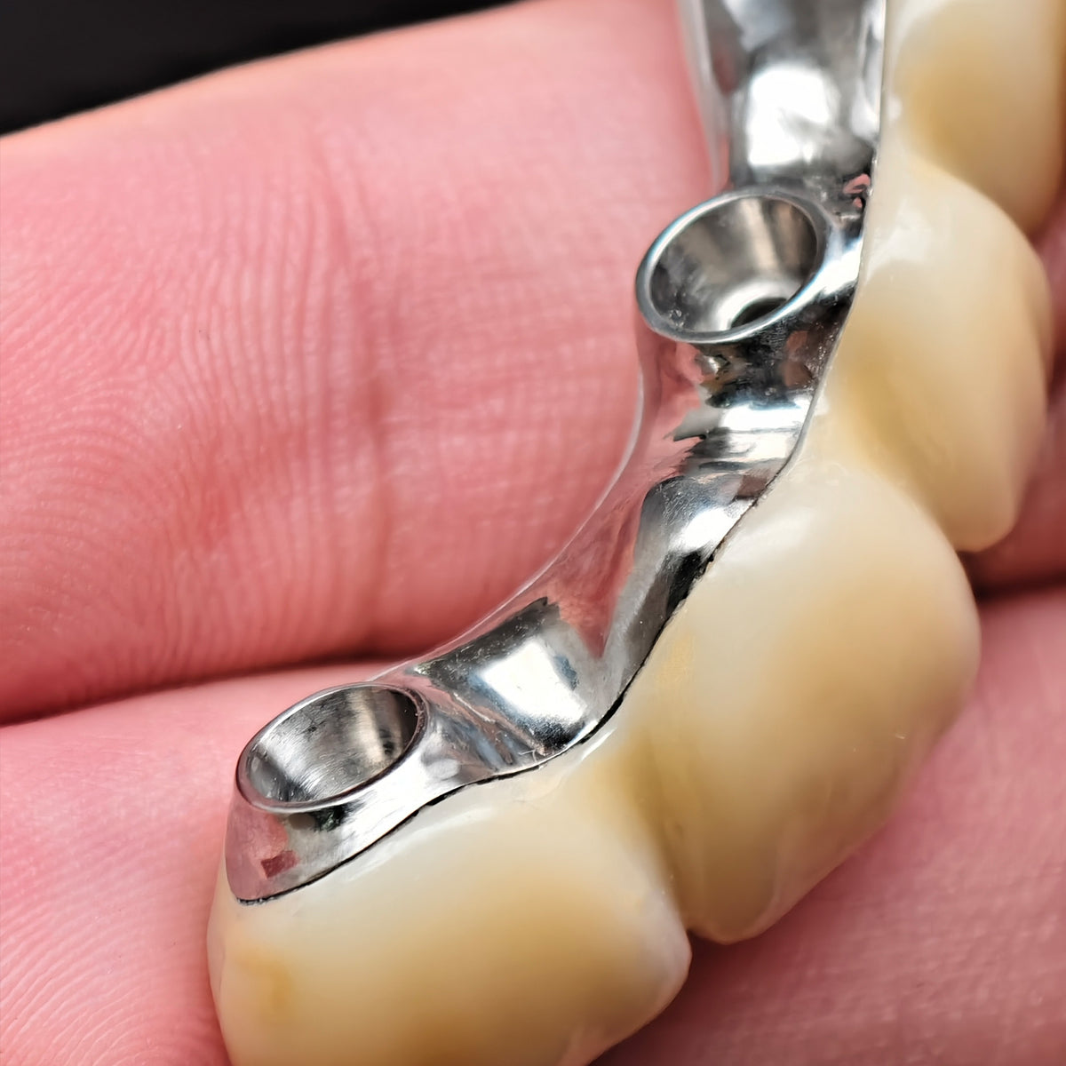 Ti-Bar Pure Titanium Metal Frame With Zirconia Bridge Implant