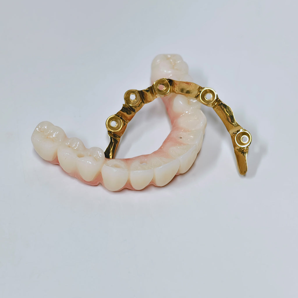 Ti-Bar Titanium Nitride Metal Frame With Zirconia Bridge For Full Arch Restoration