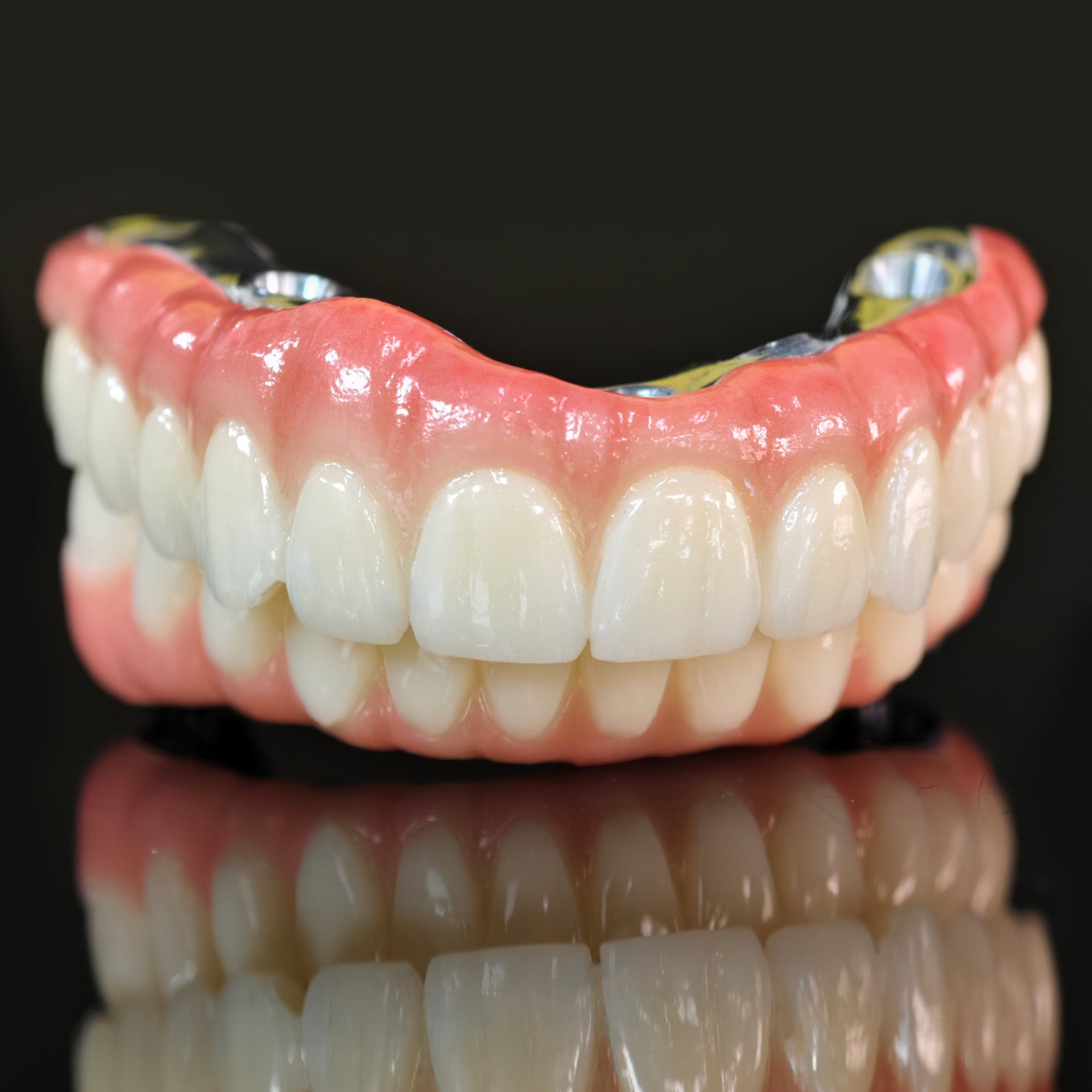 Ti-Bar Titanium Nitride Metal Frame With Zirconia Bridge For Full Arch Restoration