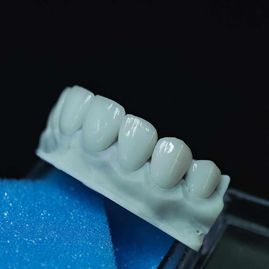 Ultra-Thin Emax Veneer. High Transparency/Translucent, Natural Shade