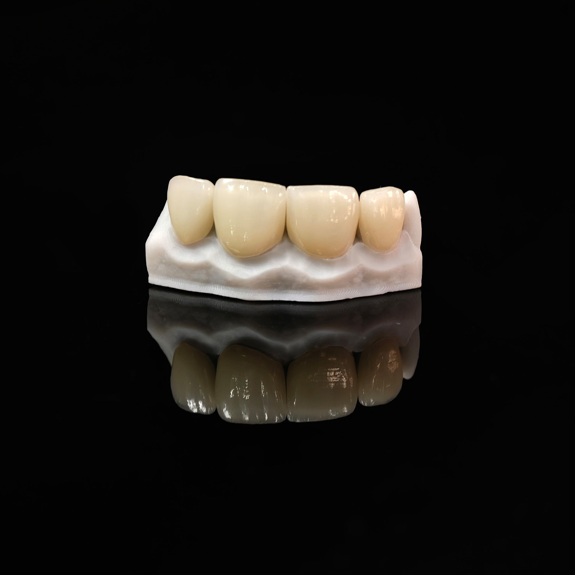 Ultra-Thin Emax Veneer. High Transparency/Translucent, Natural Shade