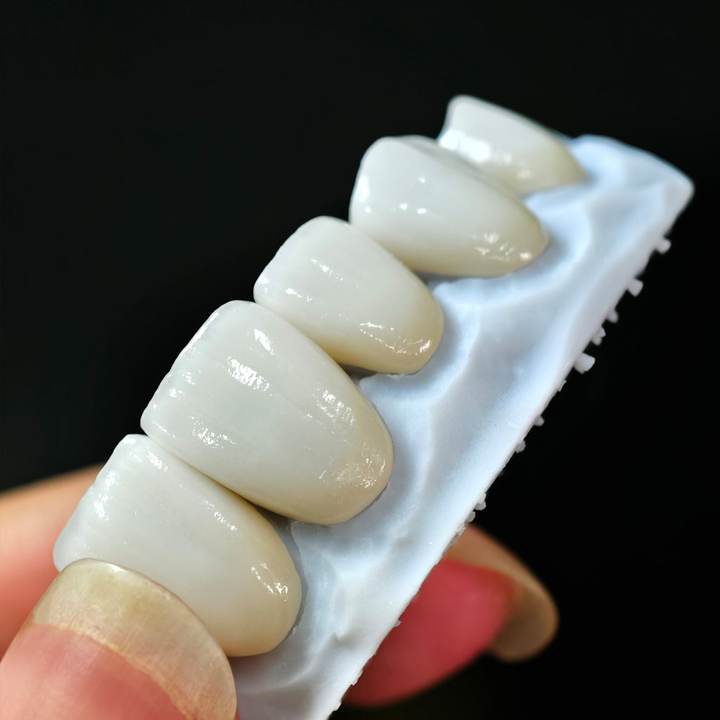 Ultra-Thin Emax Veneer. High Transparency/Translucent, Natural Shade