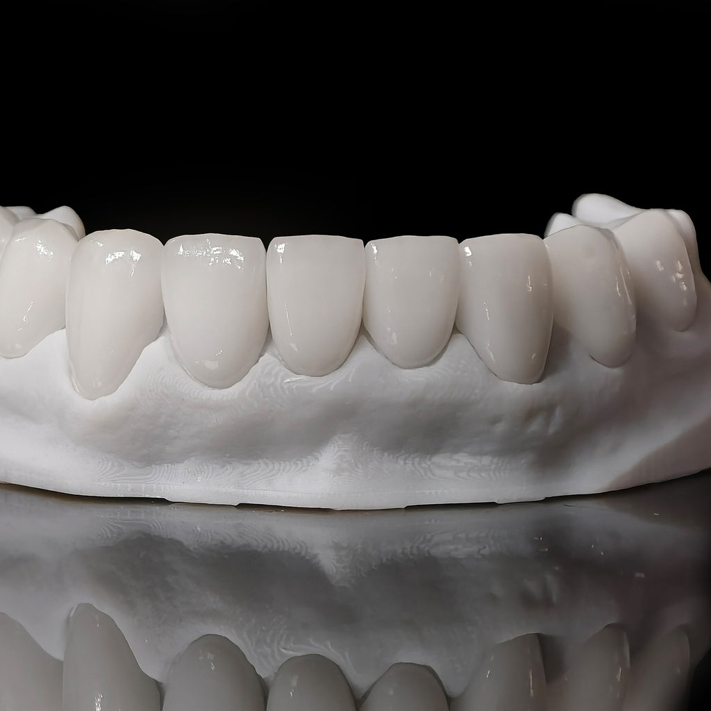 Ultra-Thin Emax Veneer. High Transparency/Translucent, Natural Shade