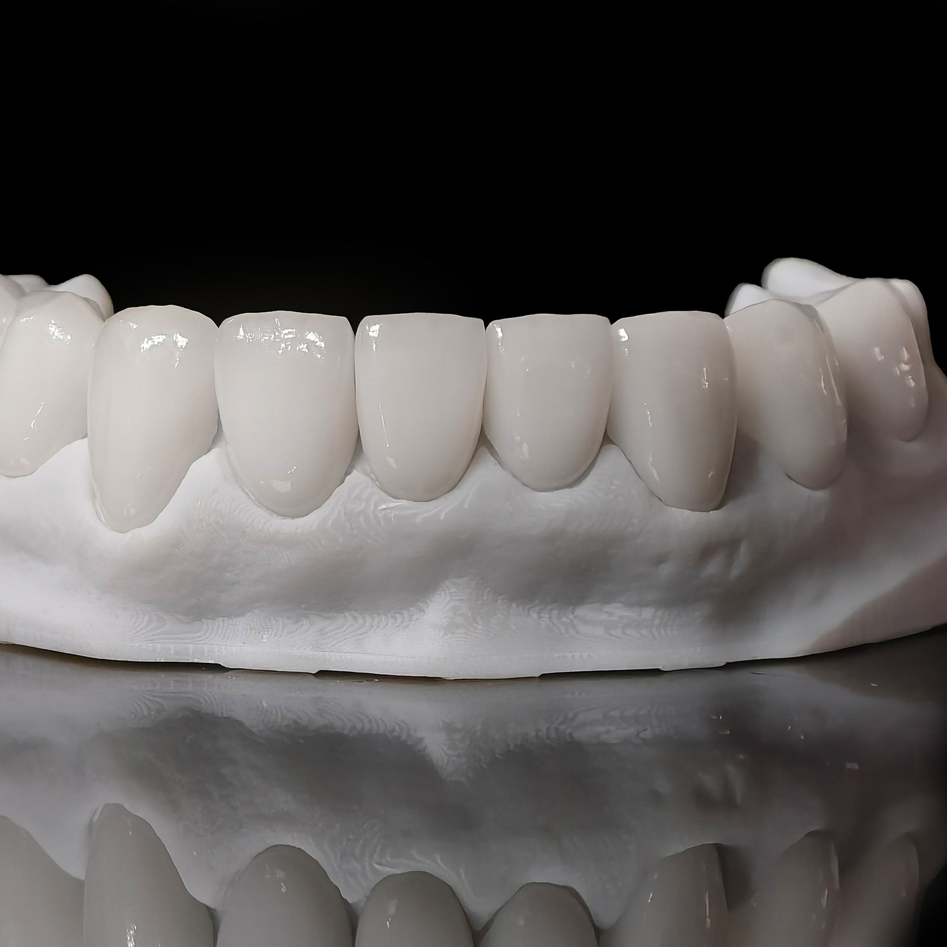 Ultra-Thin Emax Veneer. High Transparency/Translucent, Natural Shade