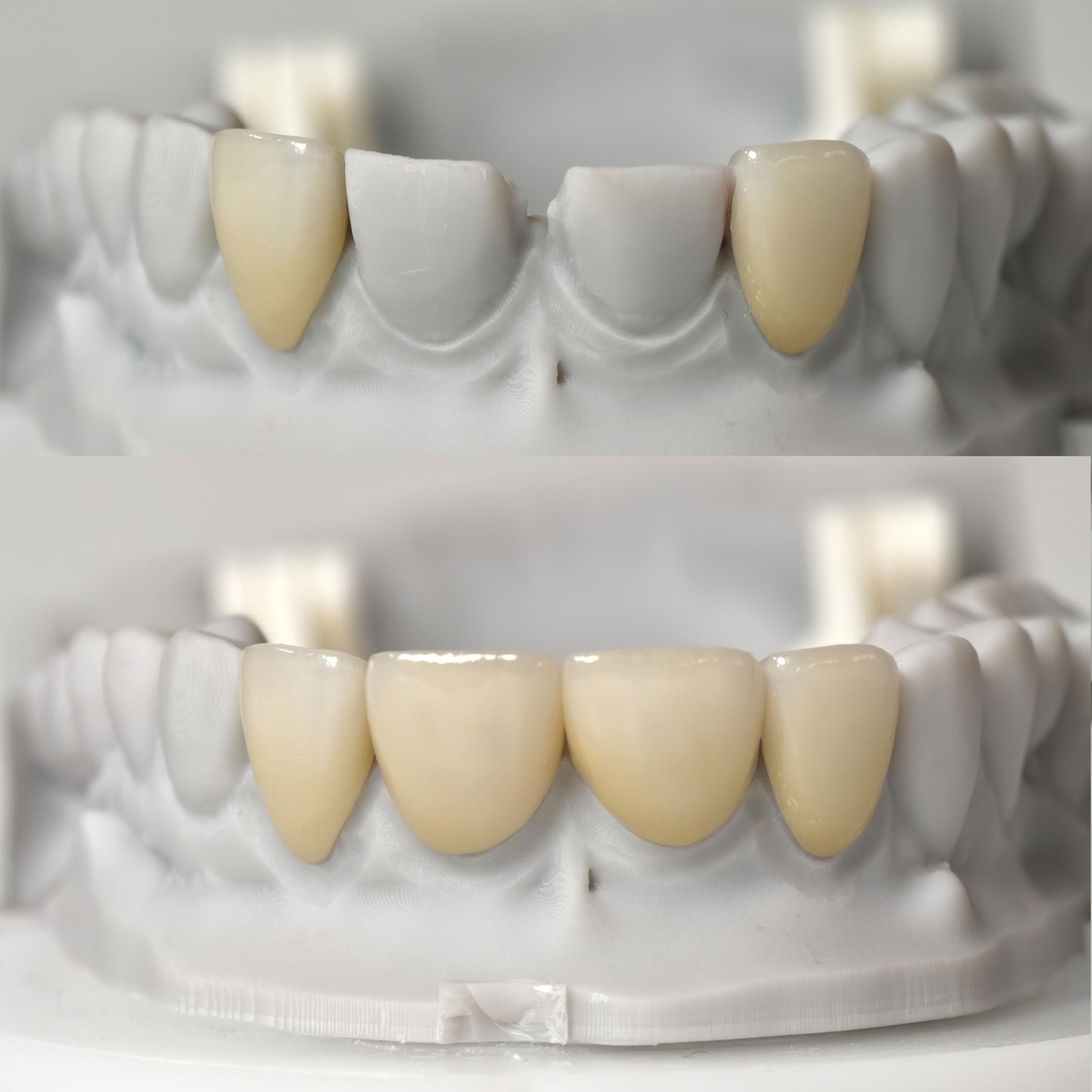Ultra-Thin Emax Veneer. High Transparency/Translucent, Natural Shade