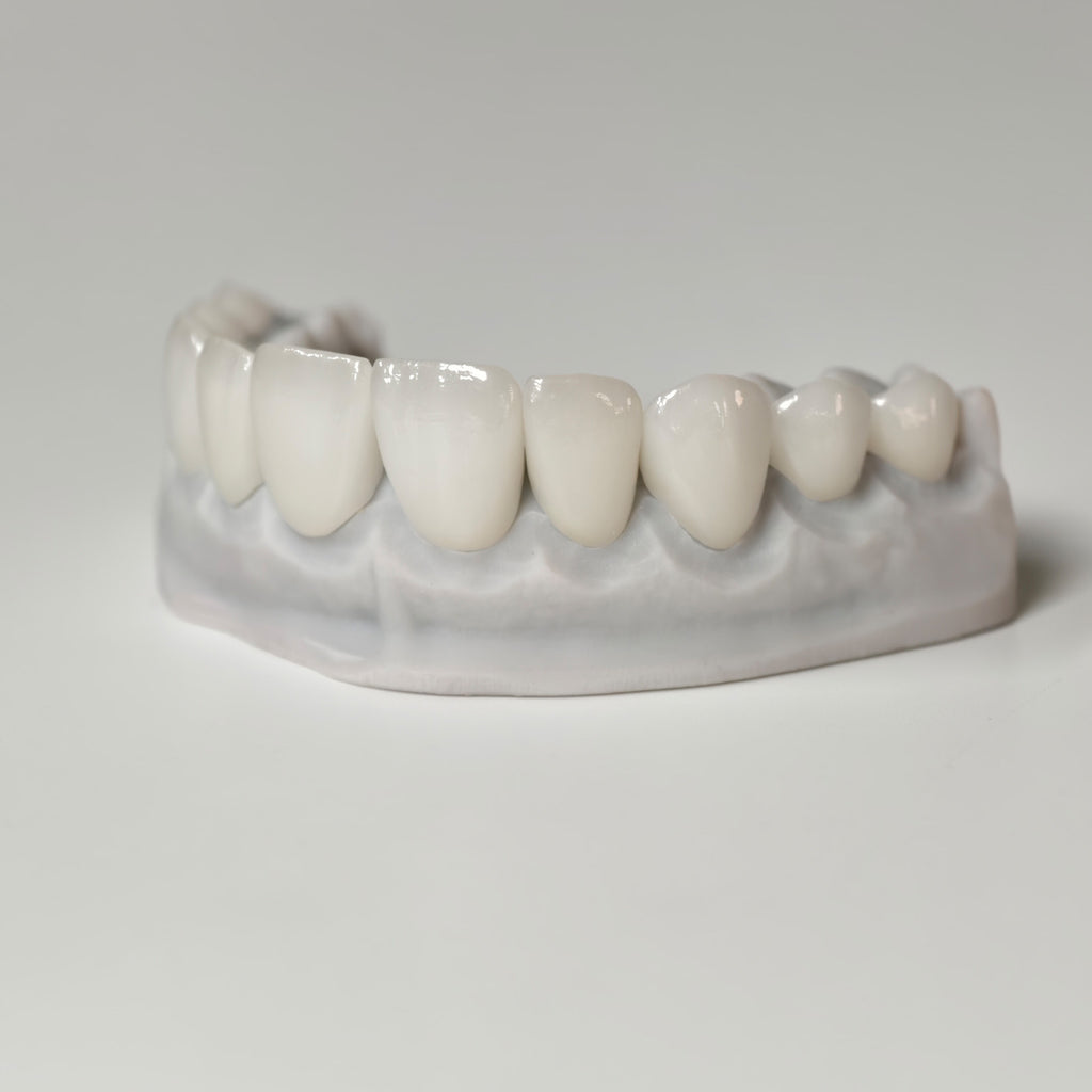 Ultra-Thin Emax Veneer. High Transparency/Translucent, Natural Shade