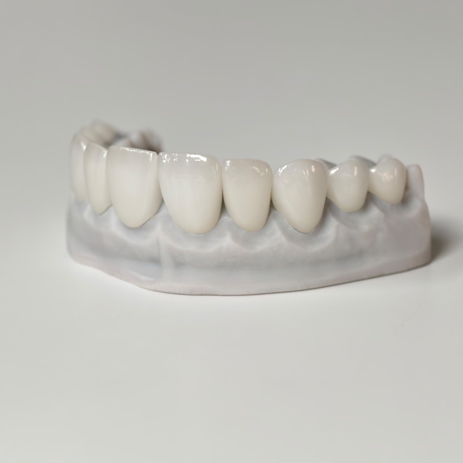 Ultra-Thin Emax Veneer. High Transparency/Translucent, Natural Shade