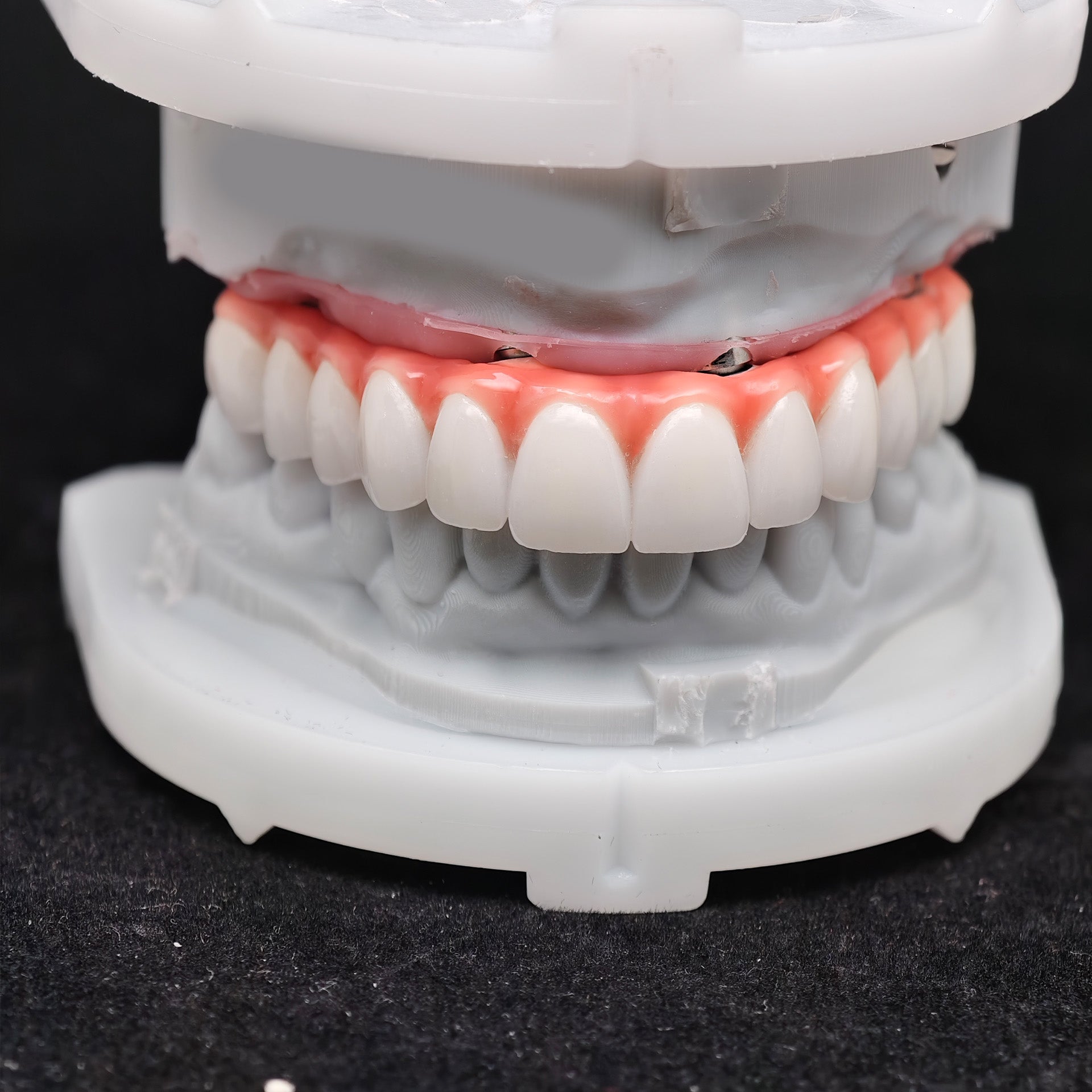Zirconia-Enamel Hybrid Malo Bridge