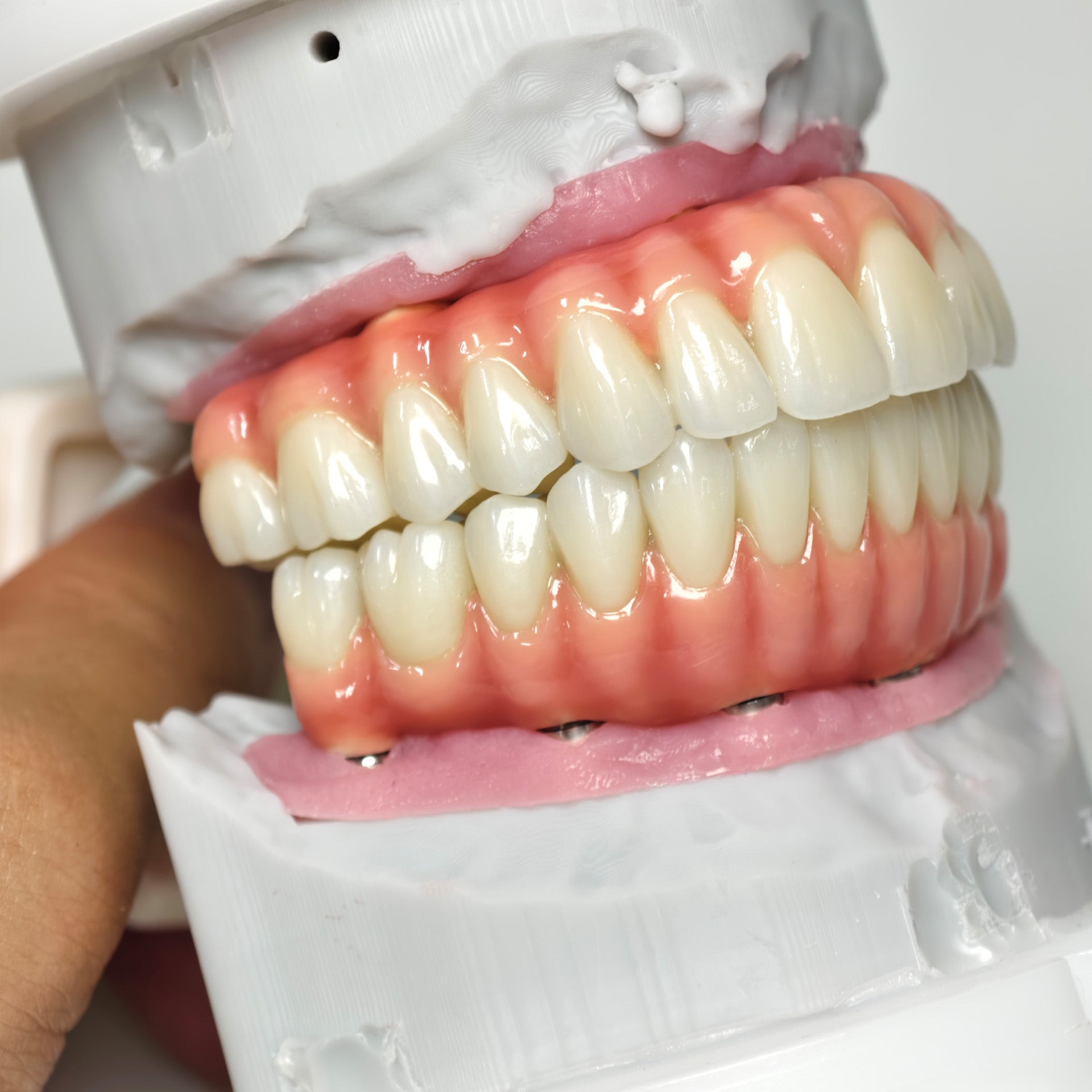 Zirconia-Enamel Hybrid Malo Bridge