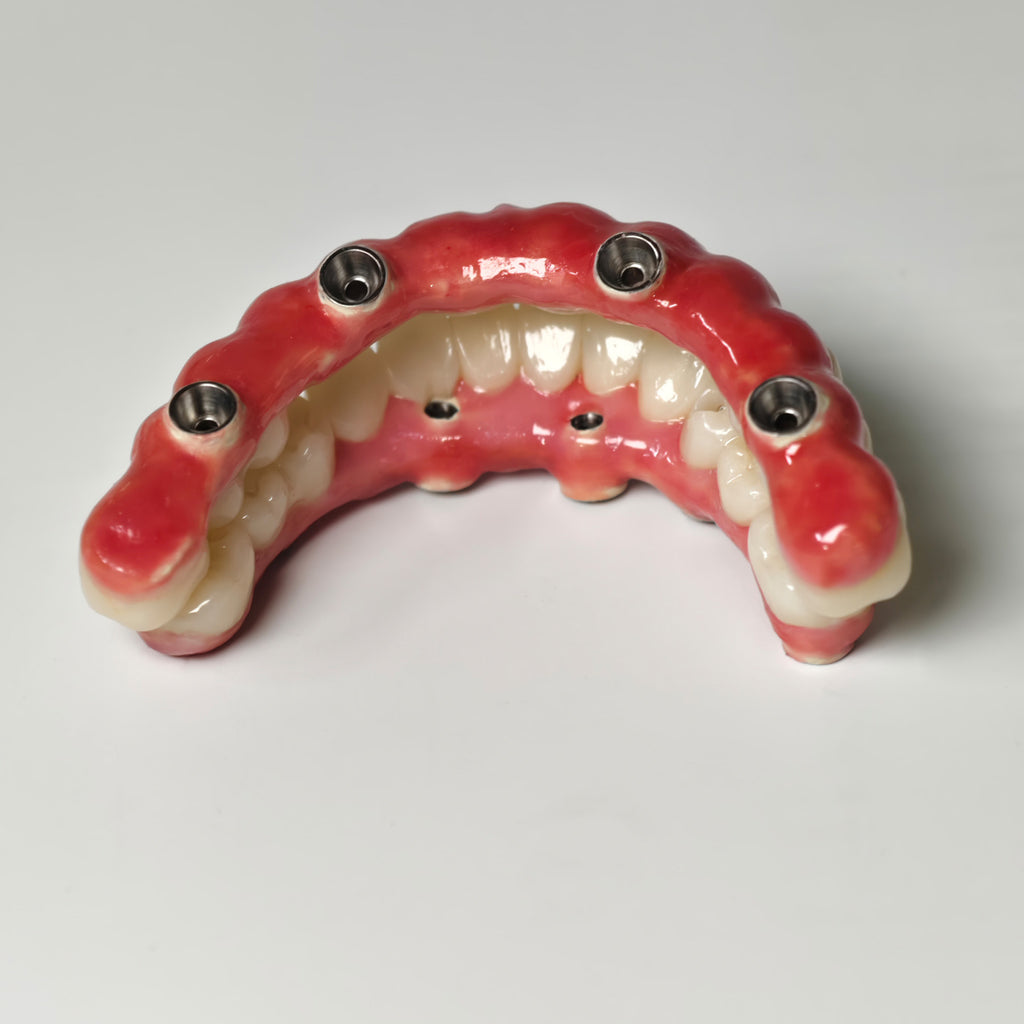 Zirconia-Enamel Hybrid Malo Bridge