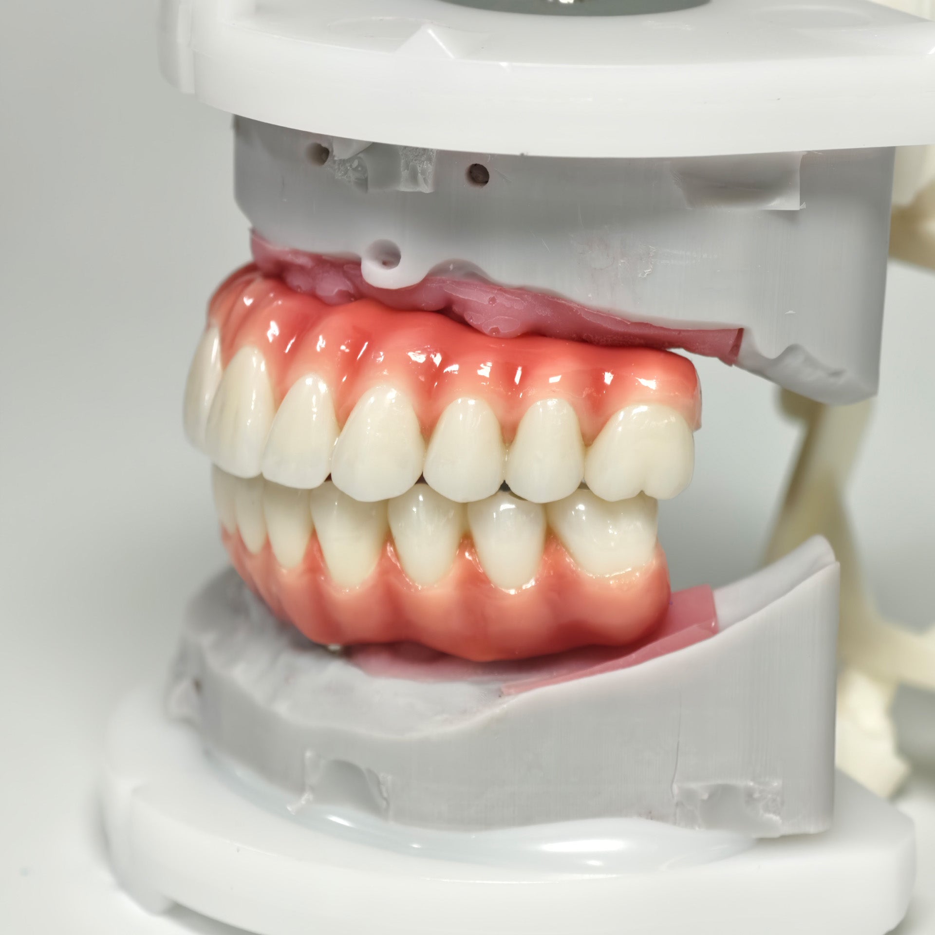 Zirconia-Enamel Hybrid Malo Bridge