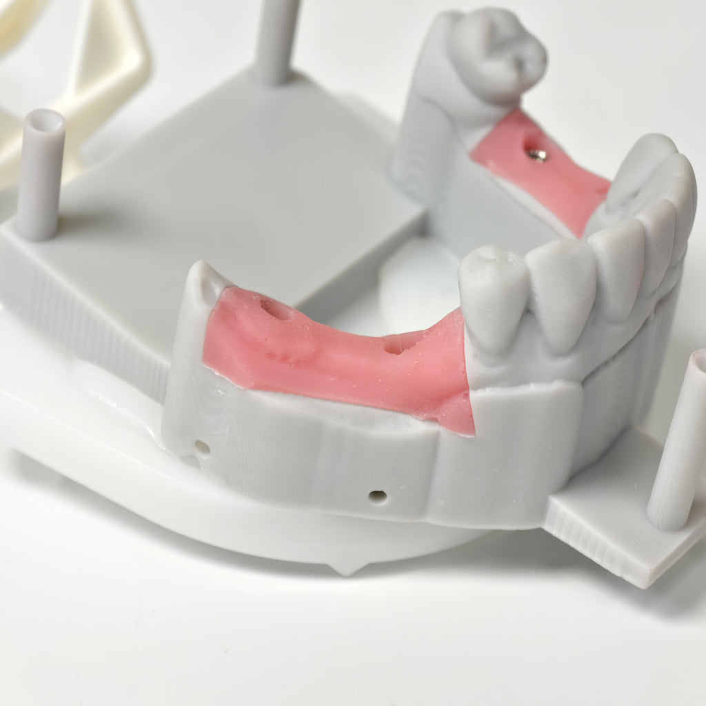 Zirconia Bridges With Screw Retained
