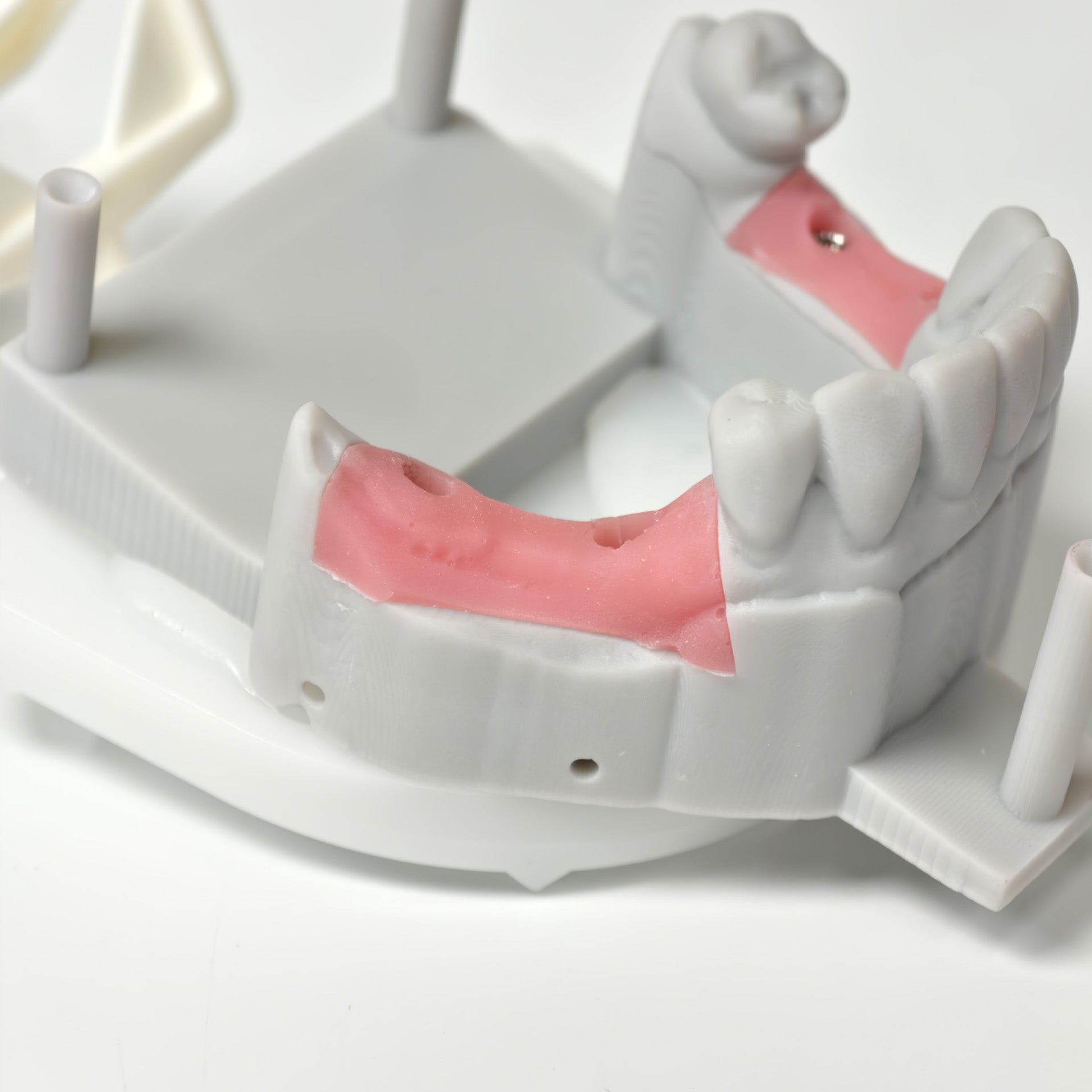 Zirconia Bridges With Screw Retained