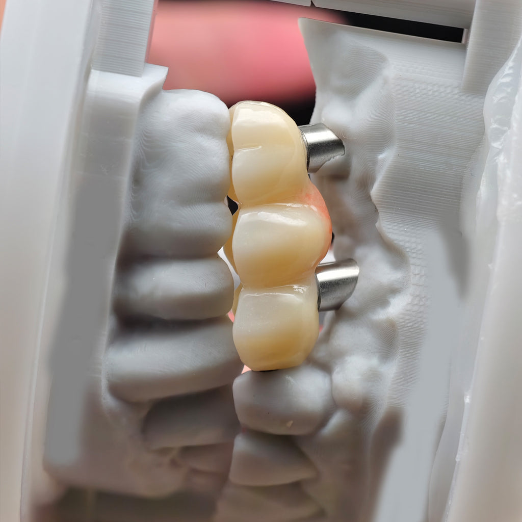Zirconia Bridge With Ti-Base Screw Retained