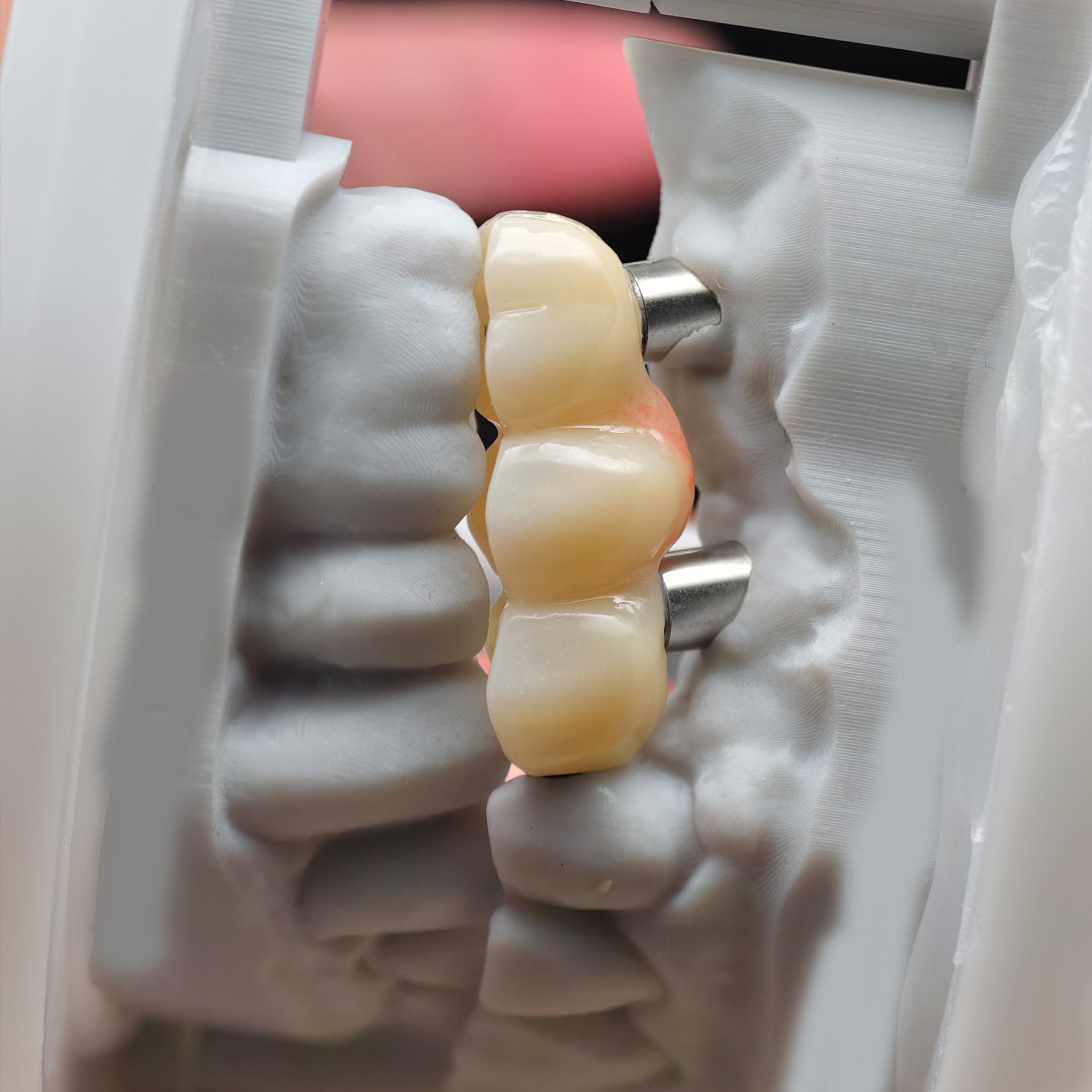 Zirconia Bridge With Ti-Base Screw Retained