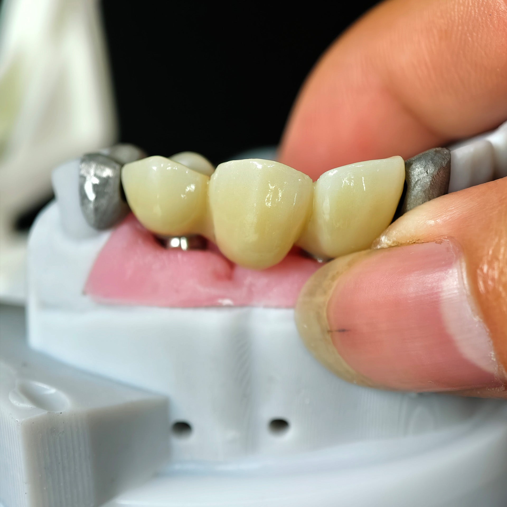 Zirconia Bridge With Ti-Base Screw Retained