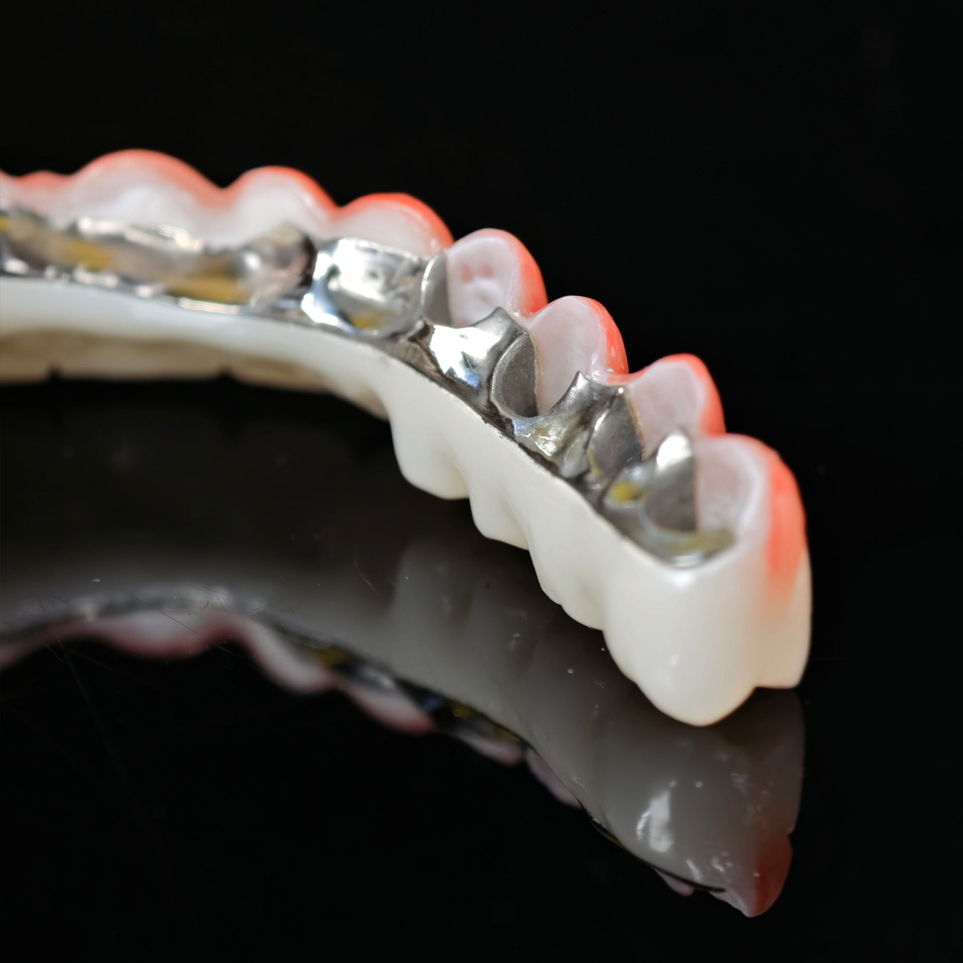 Zirconia Bridge With Cement Retained And Titanium Bar