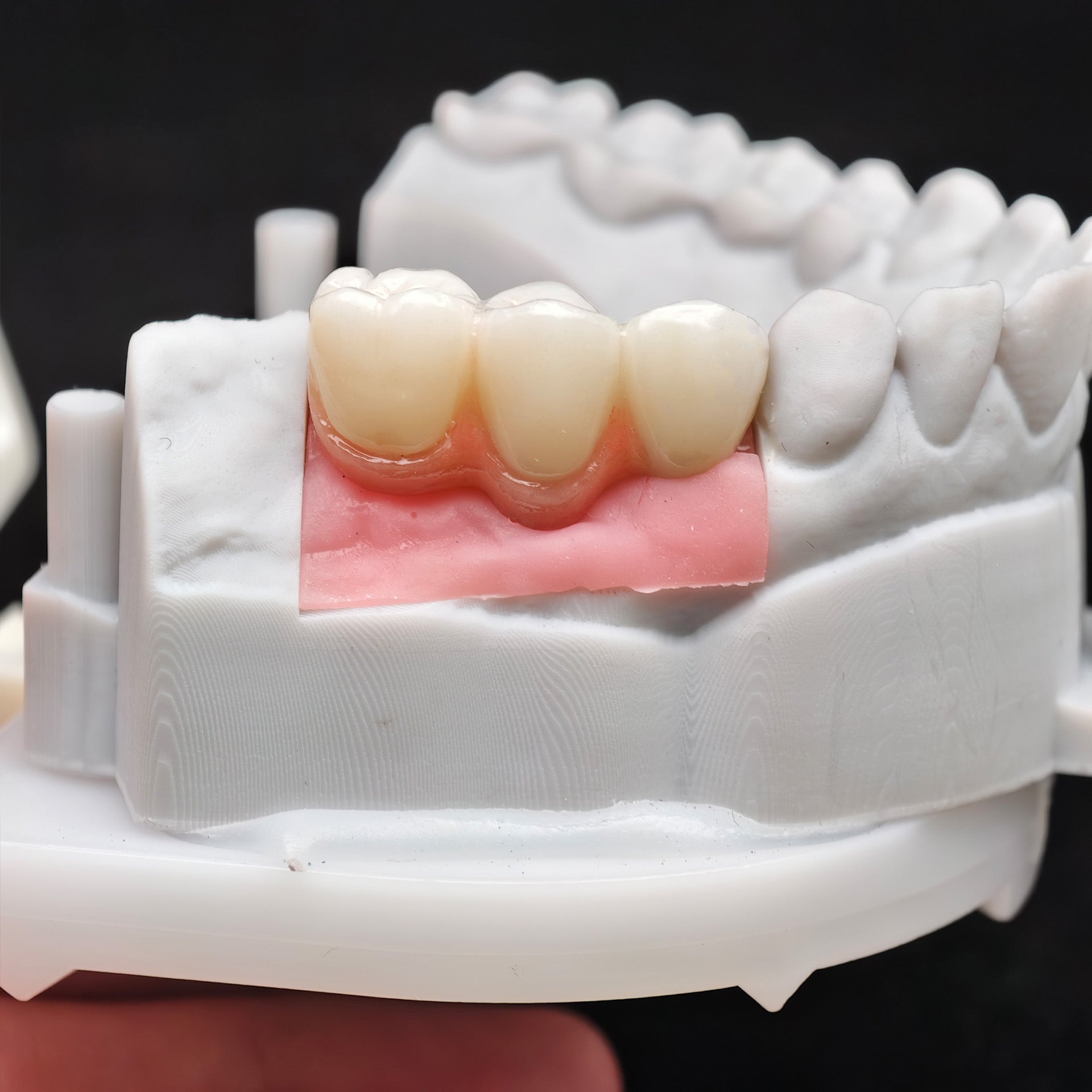 Zirconia Bridge With Screw Retained