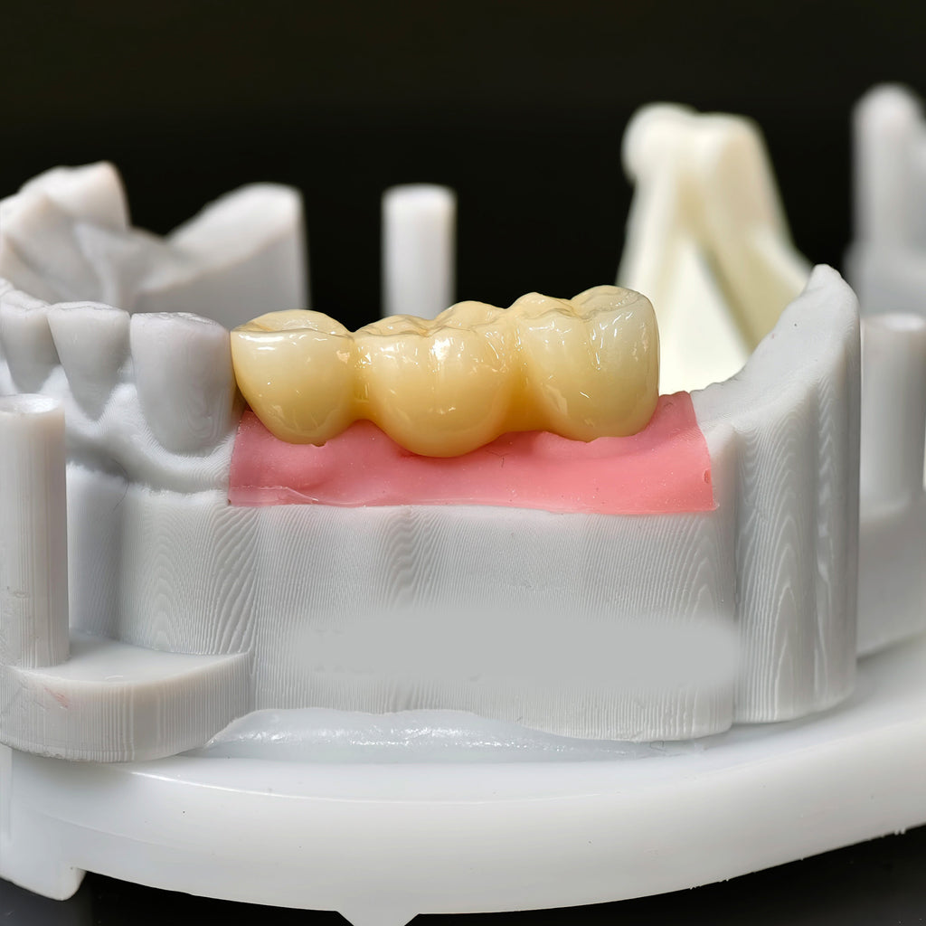 Zirconia Bridge With Screw Retained