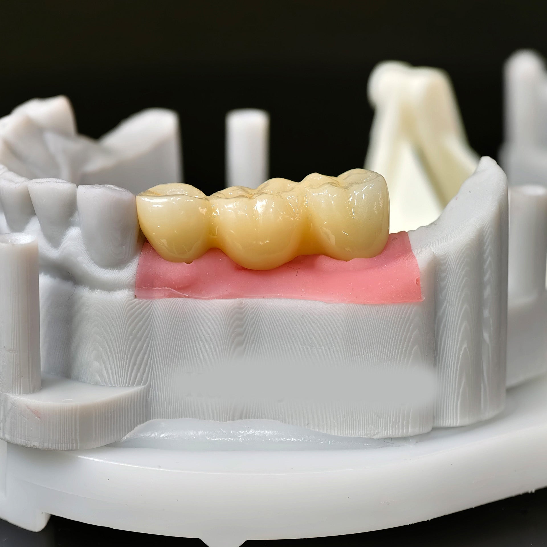 Zirconia Bridge With Screw Retained