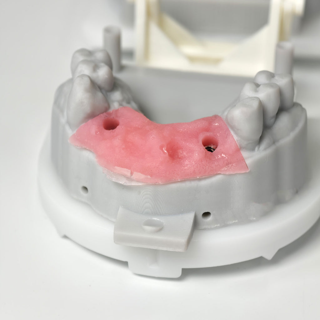 Zirconia Bridge With Screw Retained