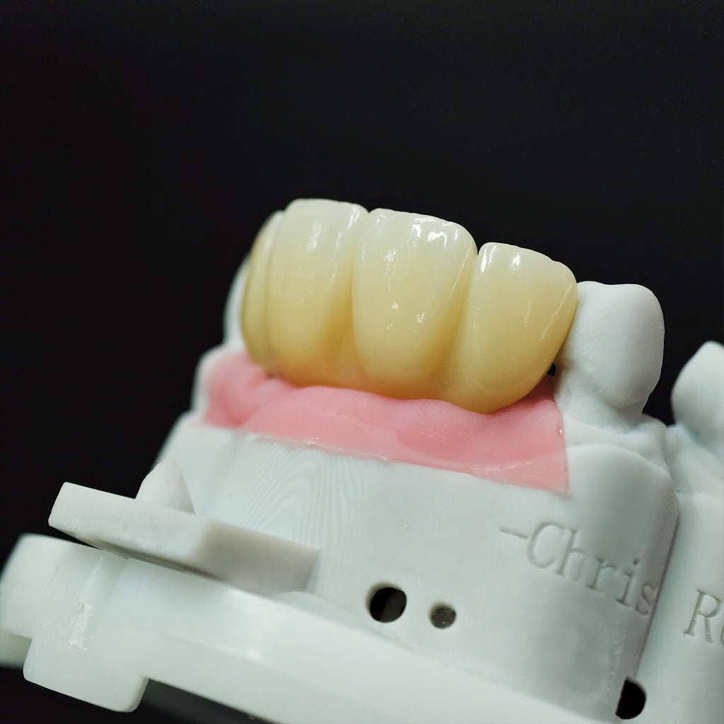Zirconia Bridge With Screw Retained