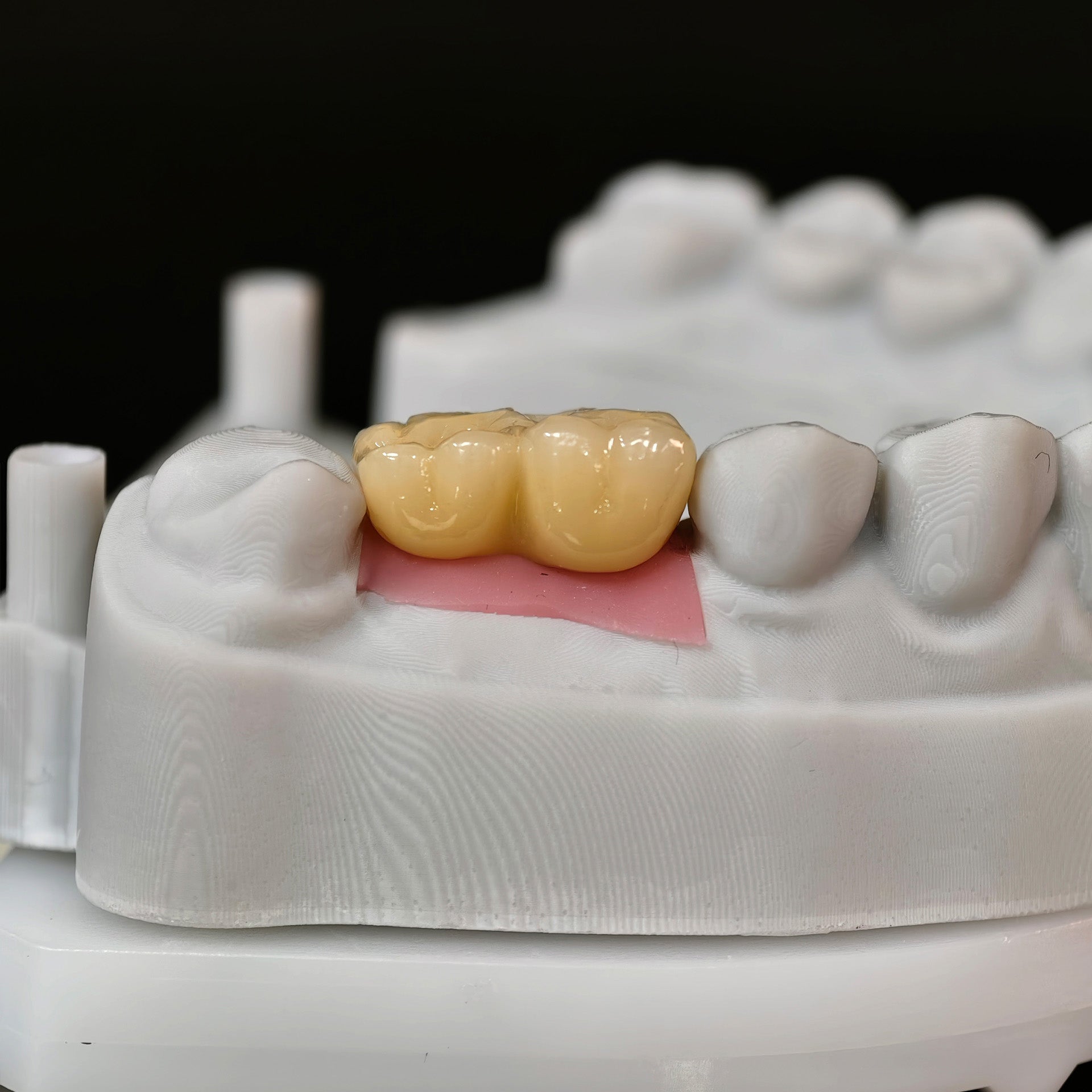Zirconia Bridge With Screw Retained
