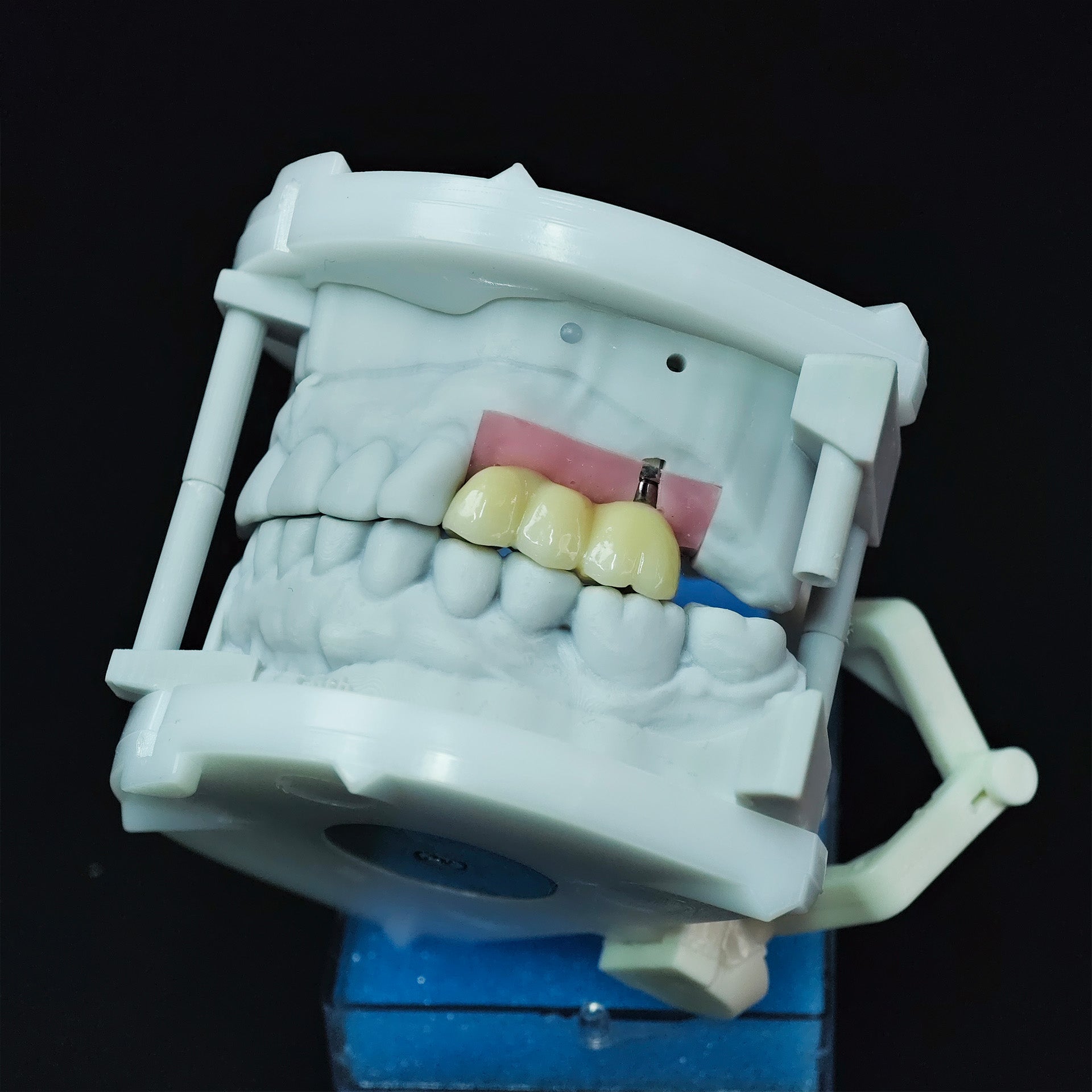 Zirconia Bridge With Screw Retained