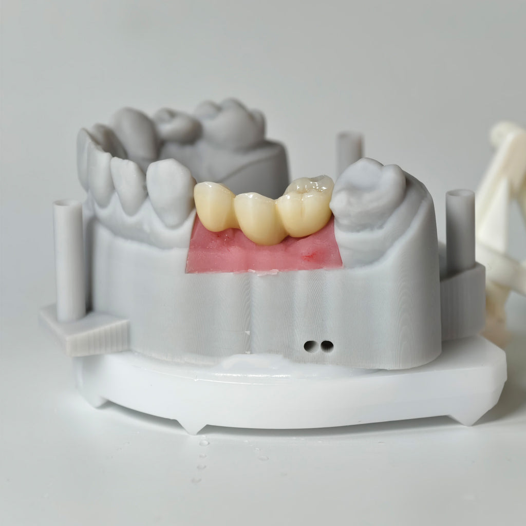 Zirconia Bridgewith Screw Retained