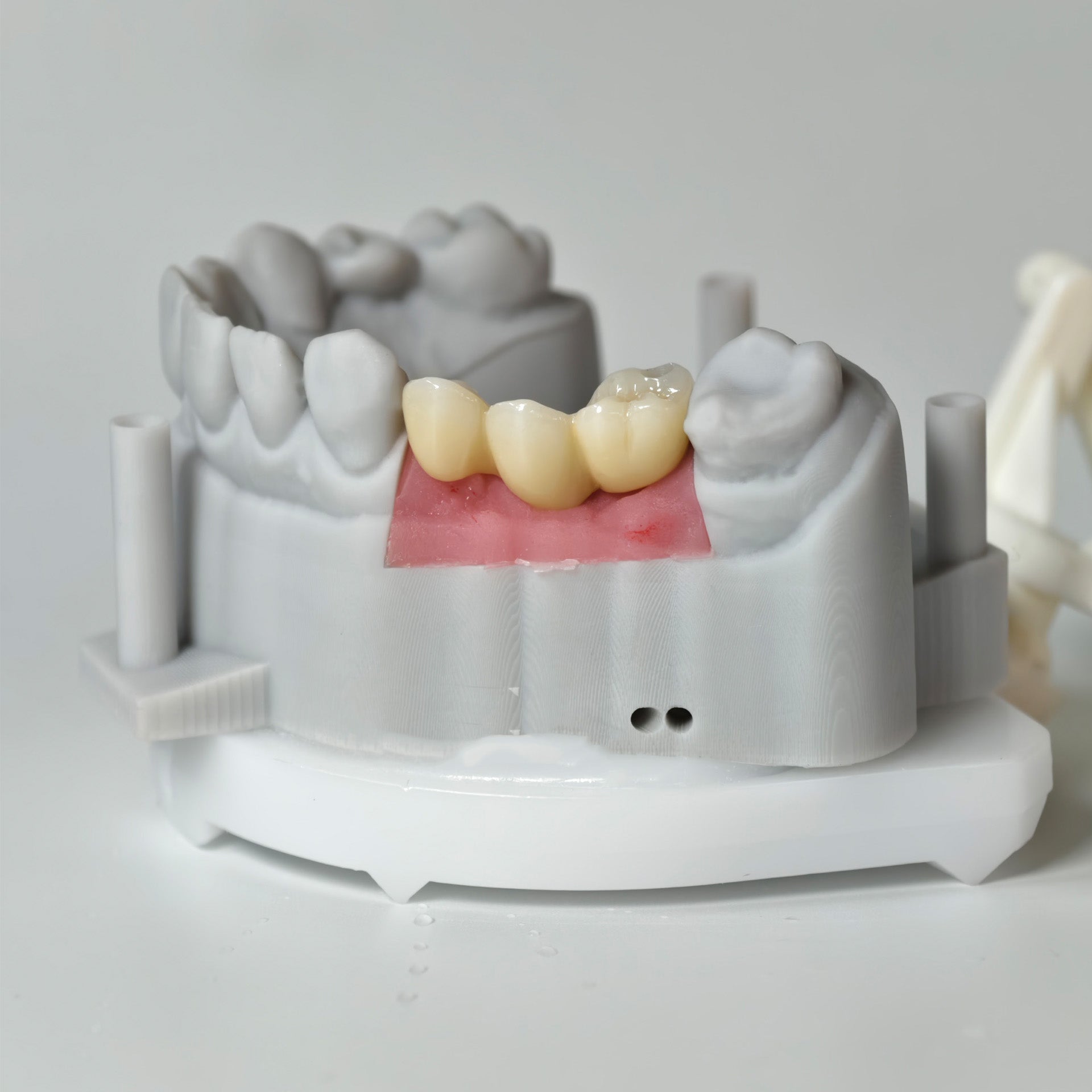 Zirconia Bridgewith Screw Retained