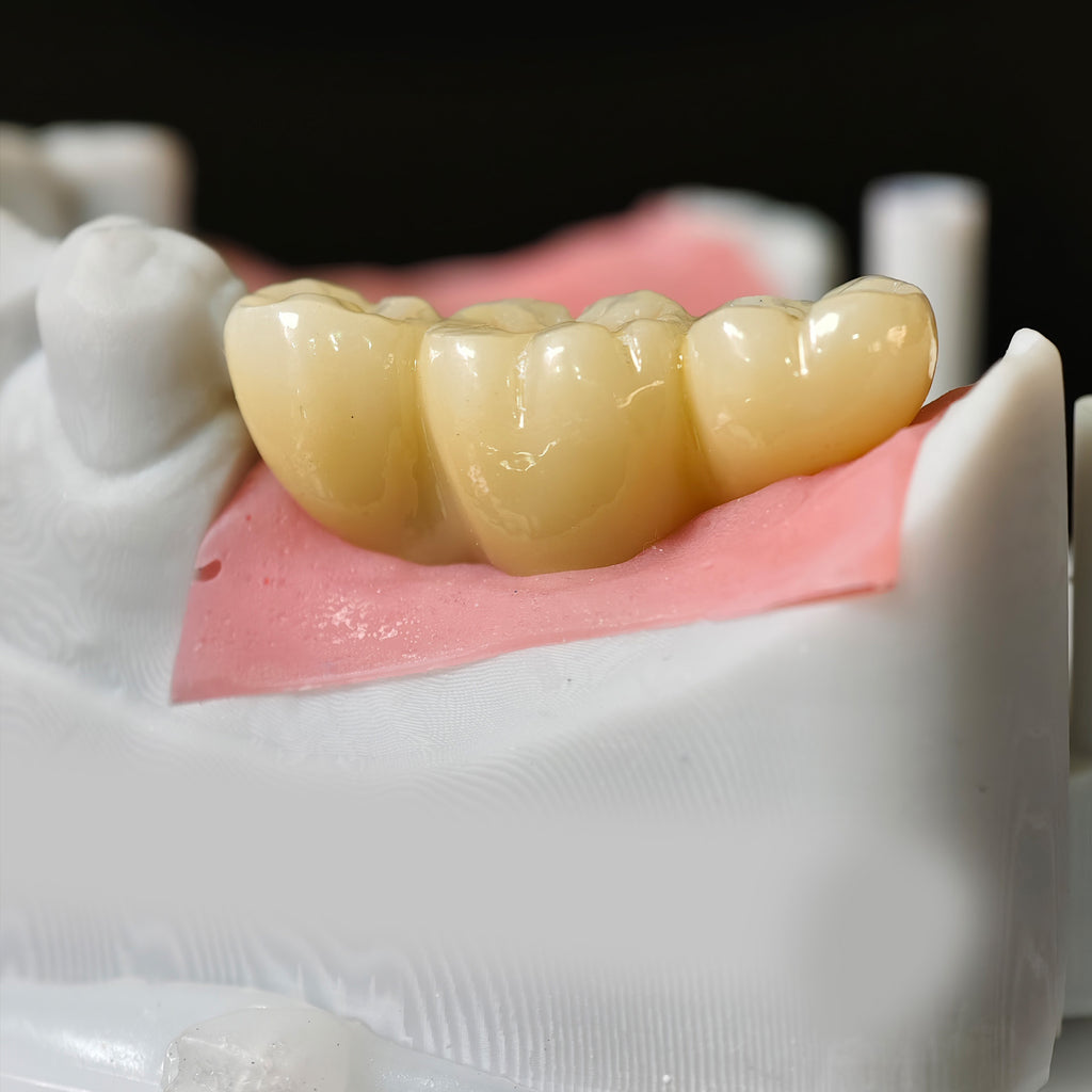 Zirconia Bridge With Screw Retained Gold Plating