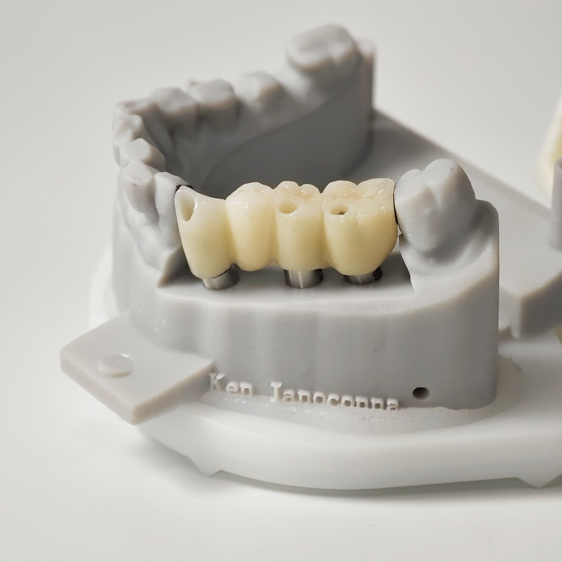 Zirconia Bridge With Ti-Base Screw Retained