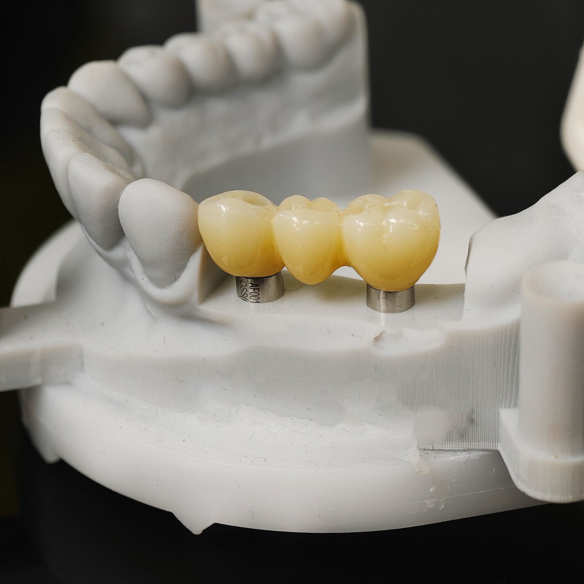 Zirconia Bridge With Ti-Base Screw Retained