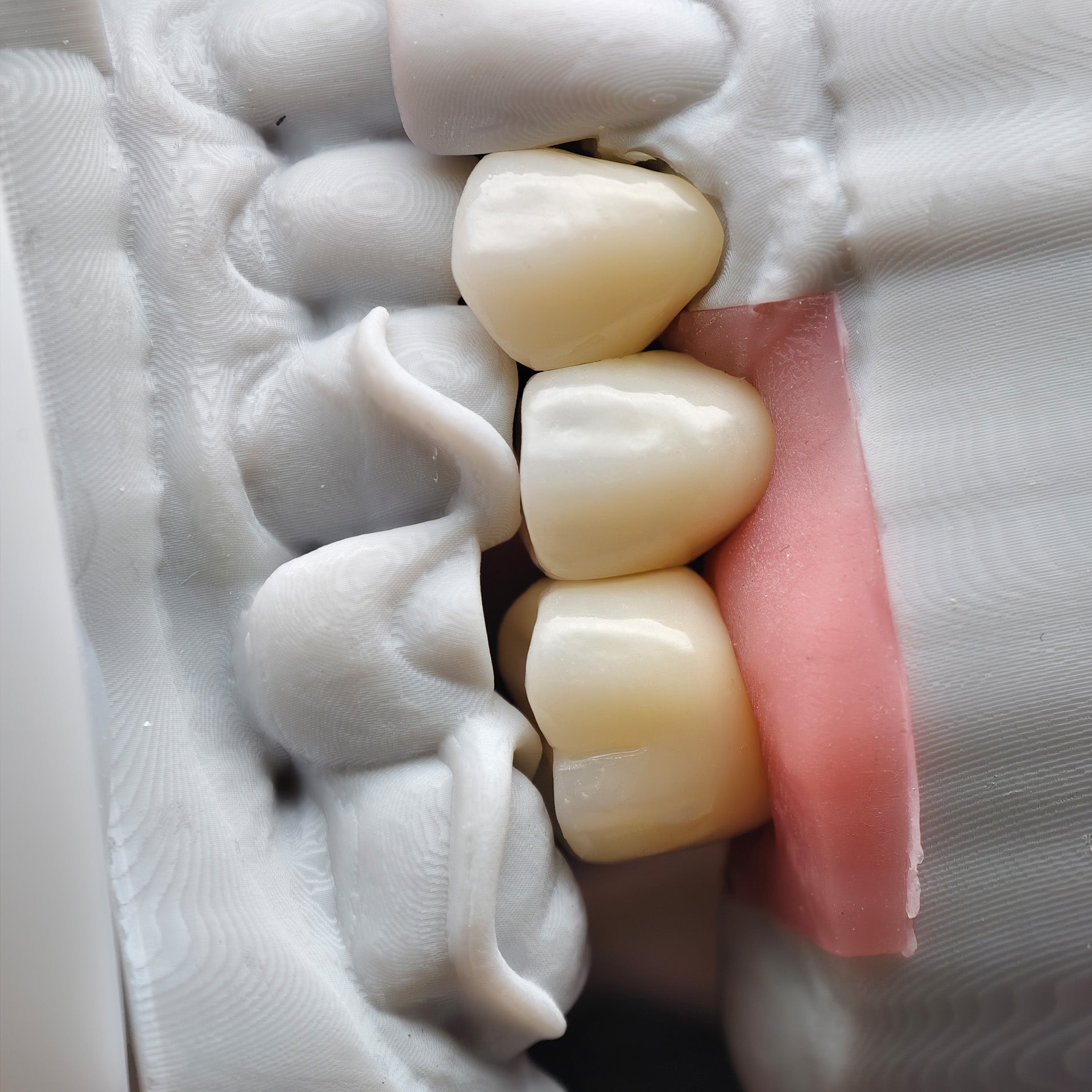 Zirconia Crown And Bridge With Screw Retained