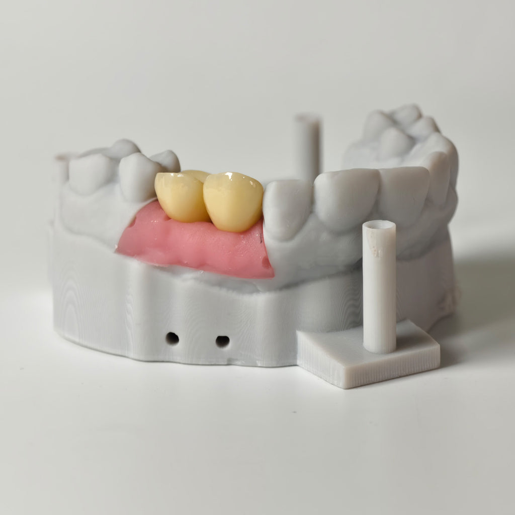 Zirconia Crowns With Gold-Plated Abutment